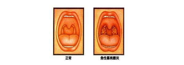 位于口咽两侧腭舌弓和腭咽弓之间的三角形扁桃体窝内