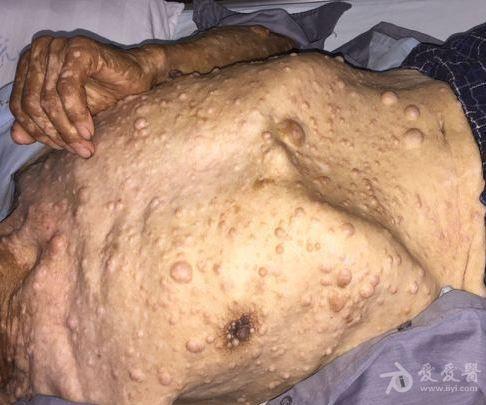 【转帖】 peutz-jeghers综合征