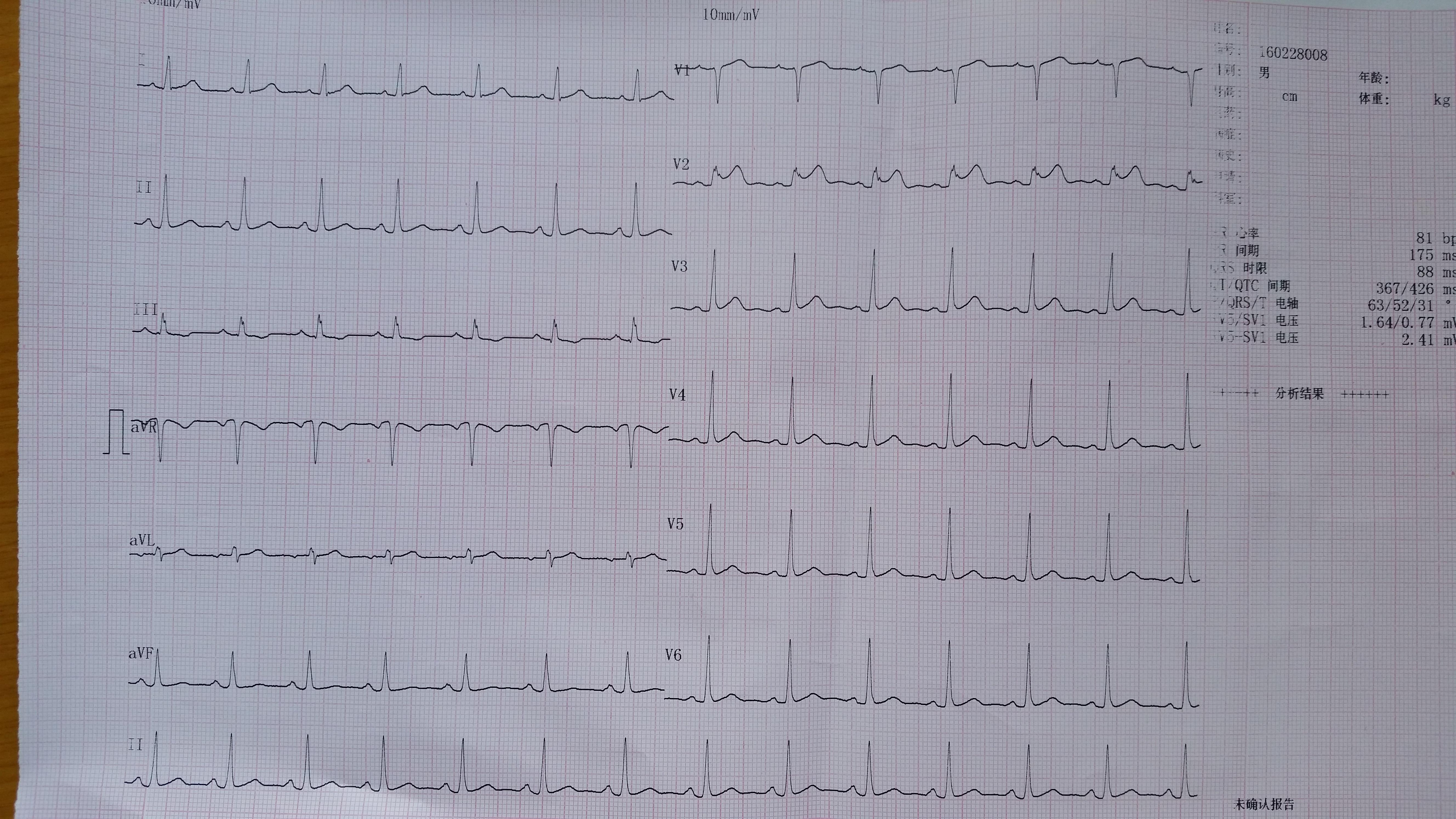 请教老师一份心电图v2导联看不懂