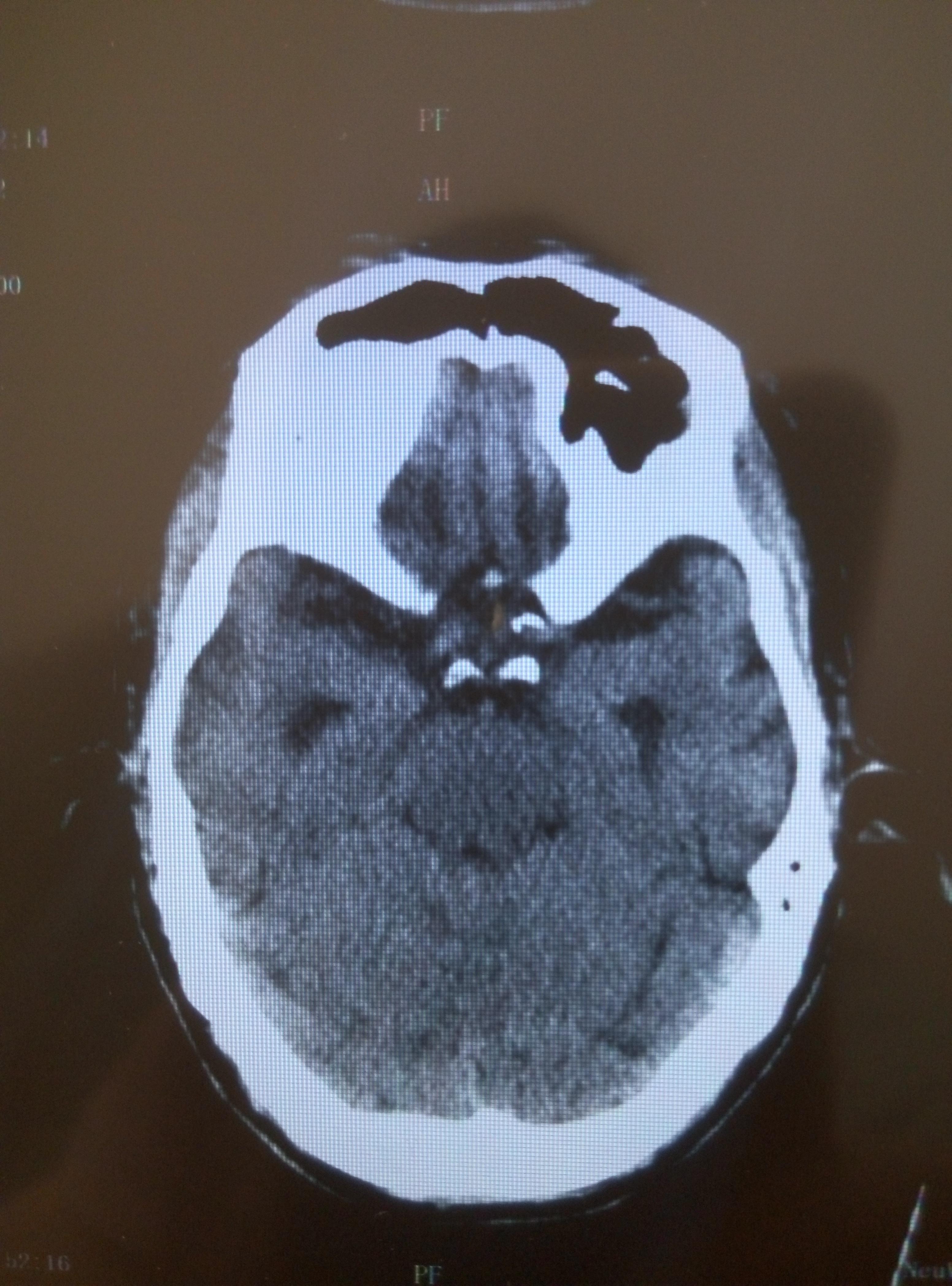 脑ct分析及病情变化分析