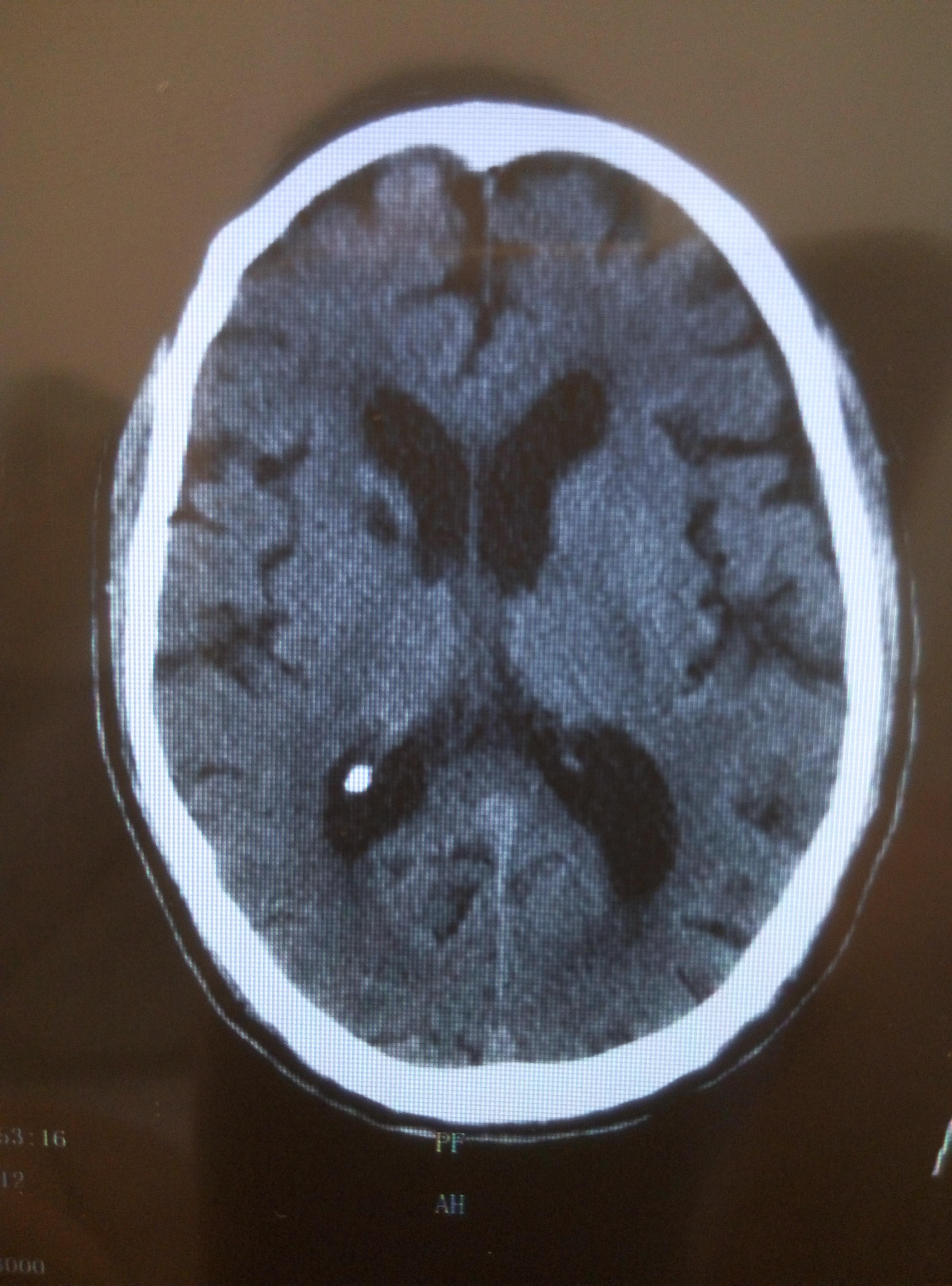 脑ct分析及病情变化分析