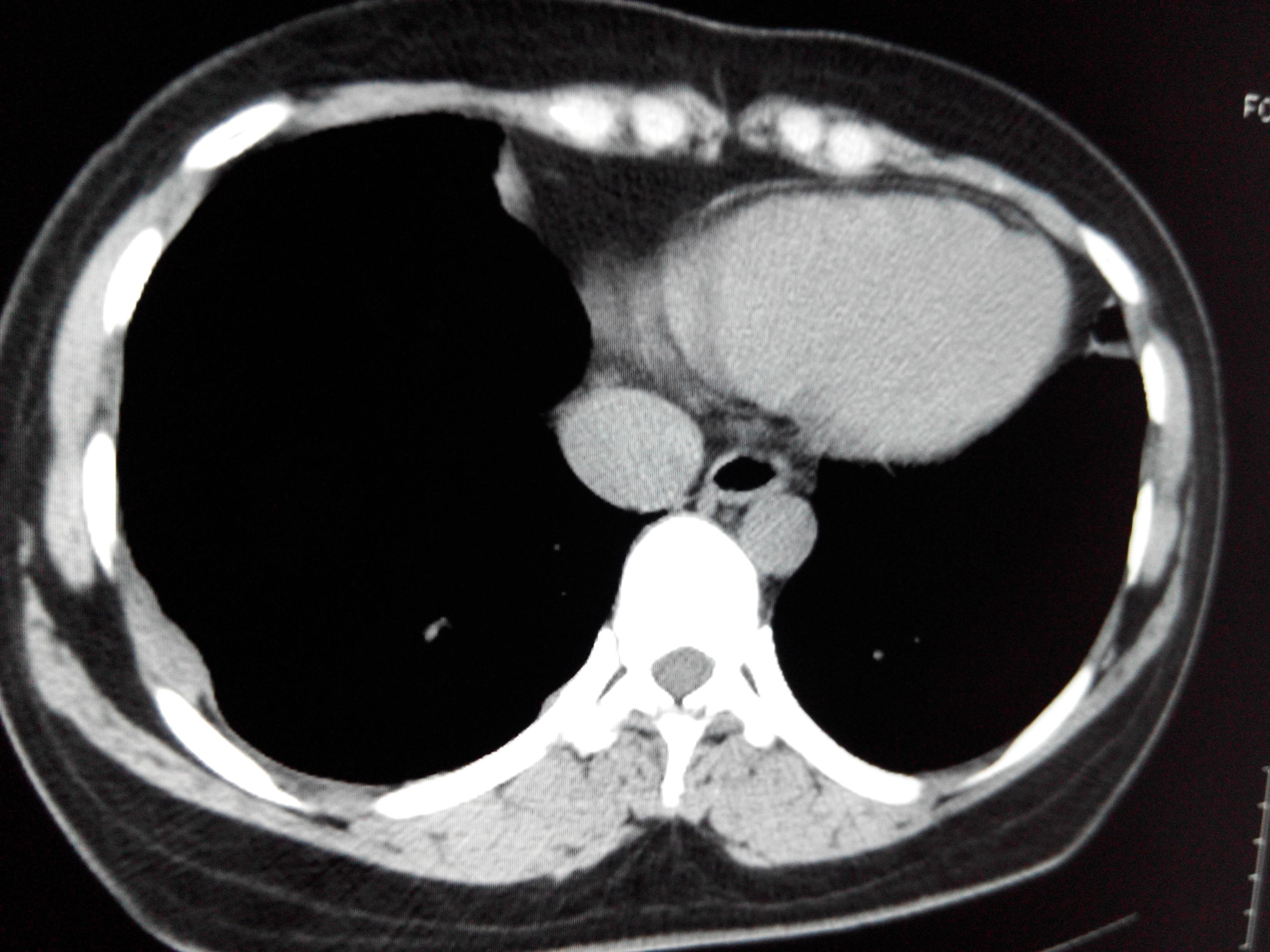 怀疑胸膜瘤病人各位同仁不吝赐教一下