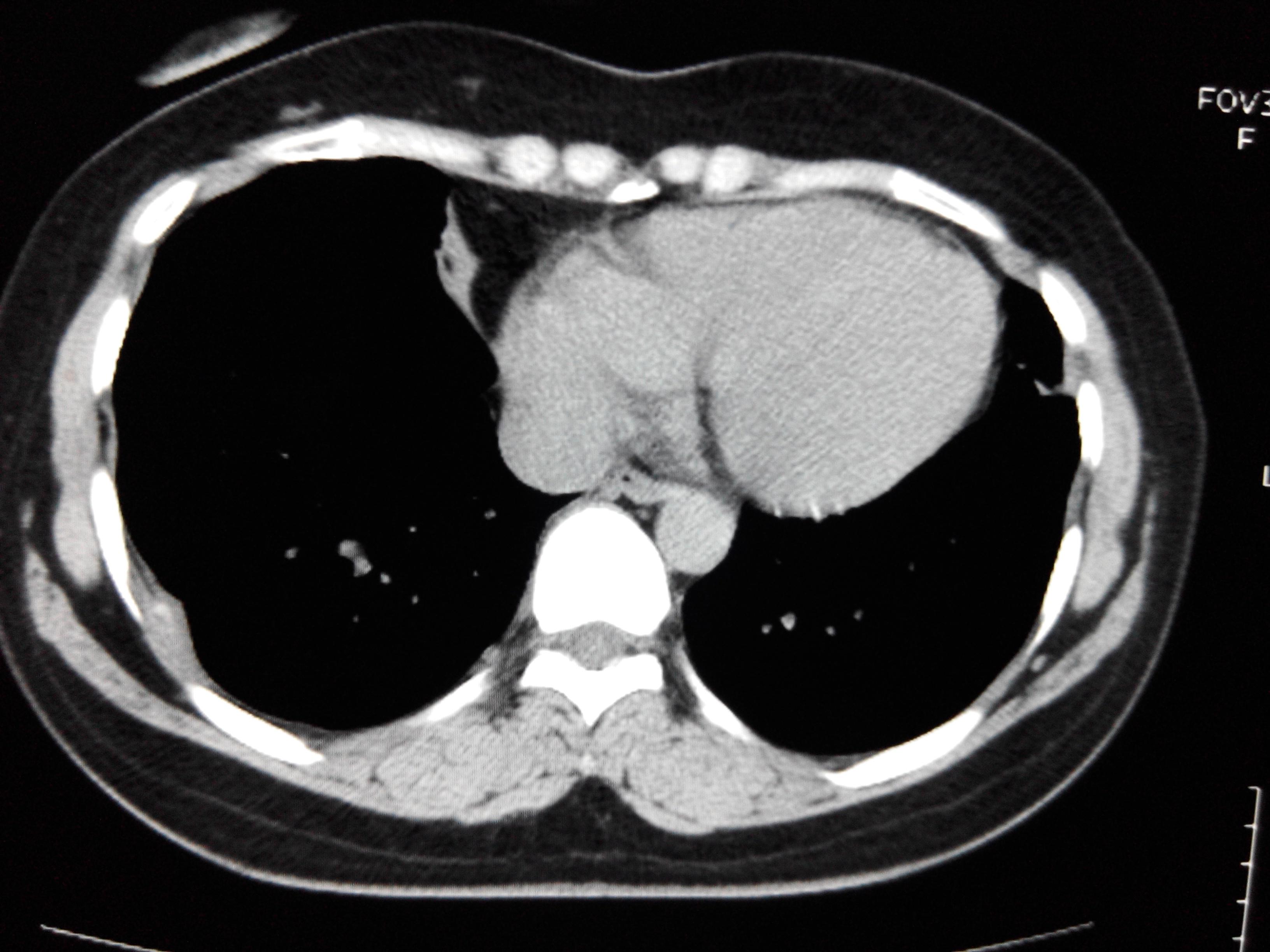 怀疑胸膜瘤病人各位同仁不吝赐教一下