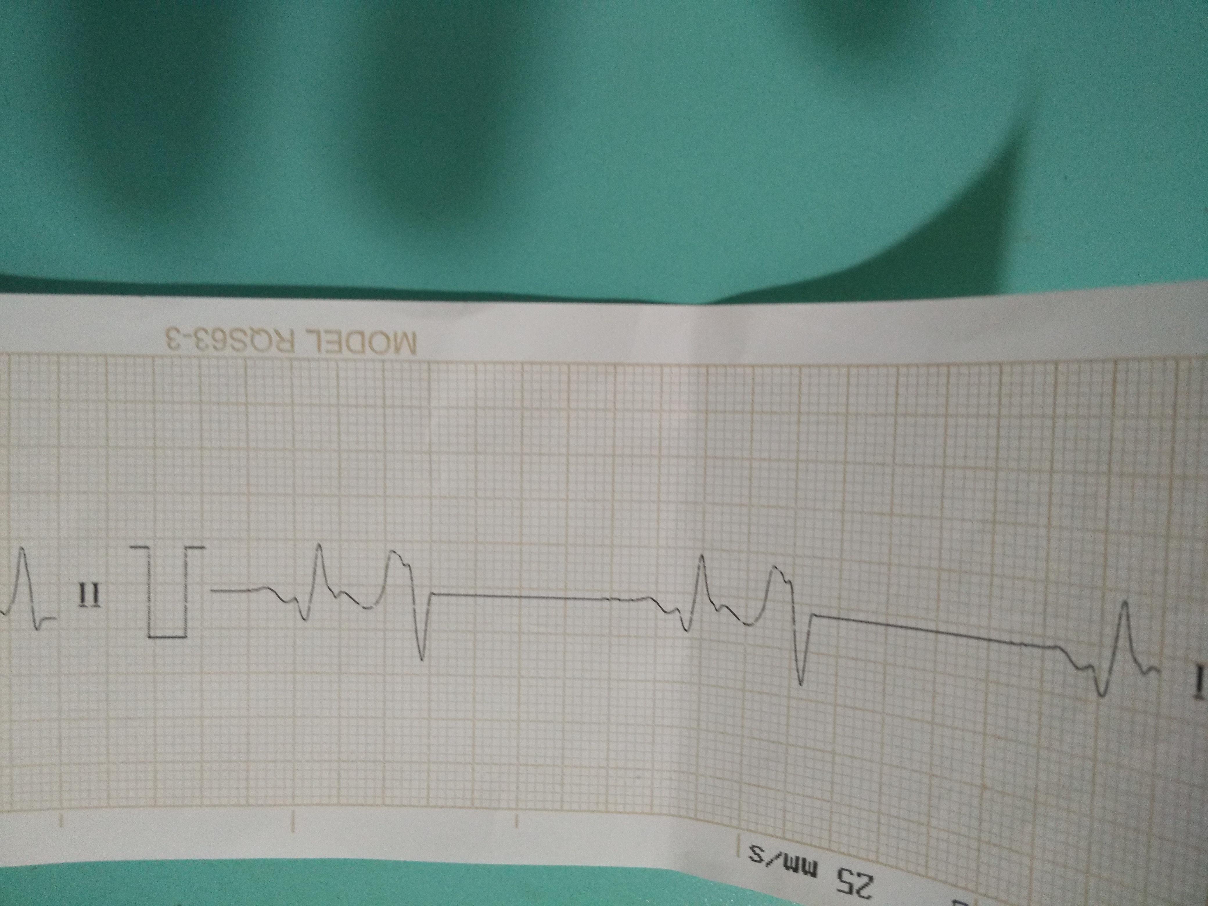 求老师指教死亡前心电图