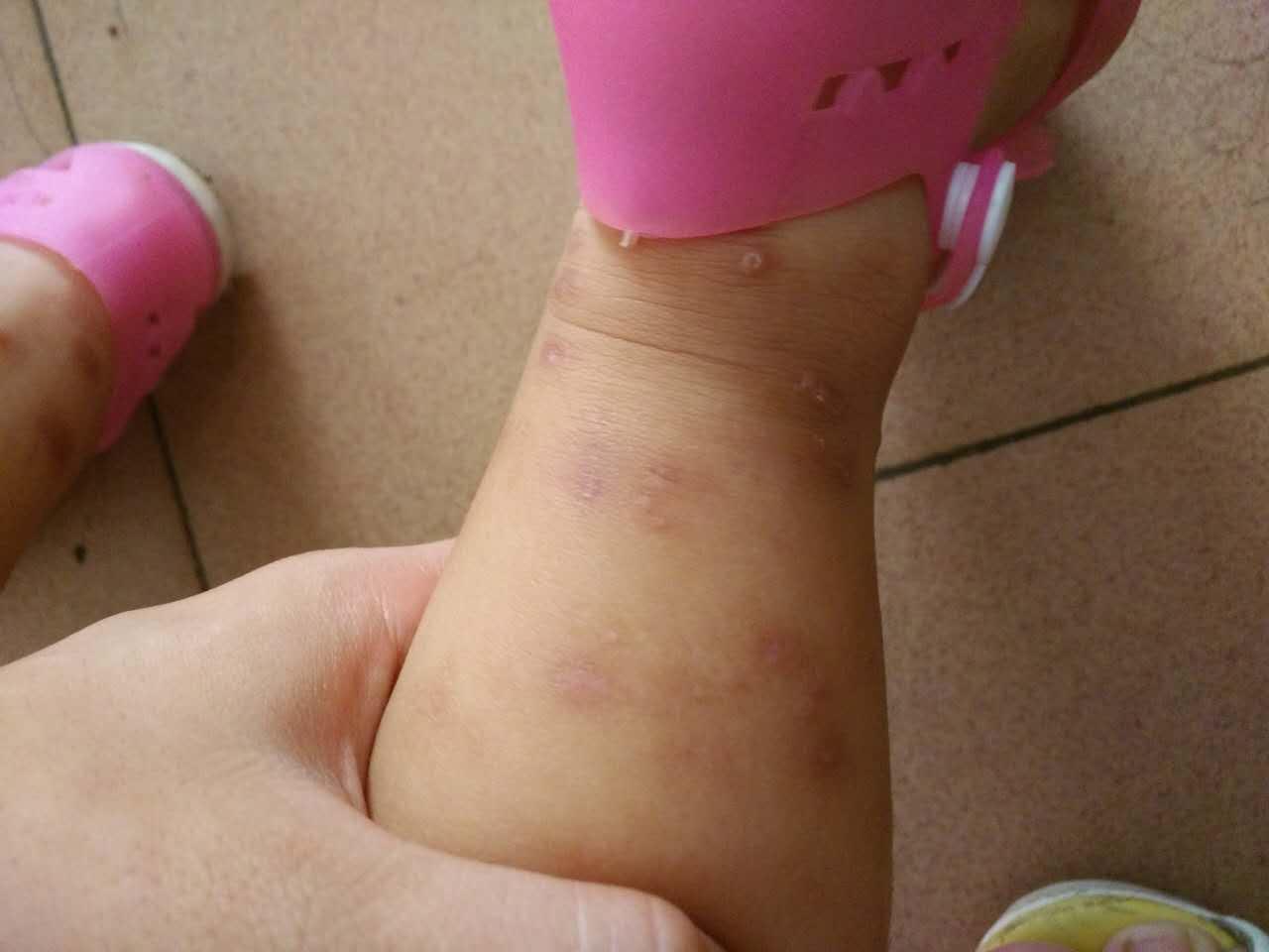 过敏性皮肤病寄生虫感染