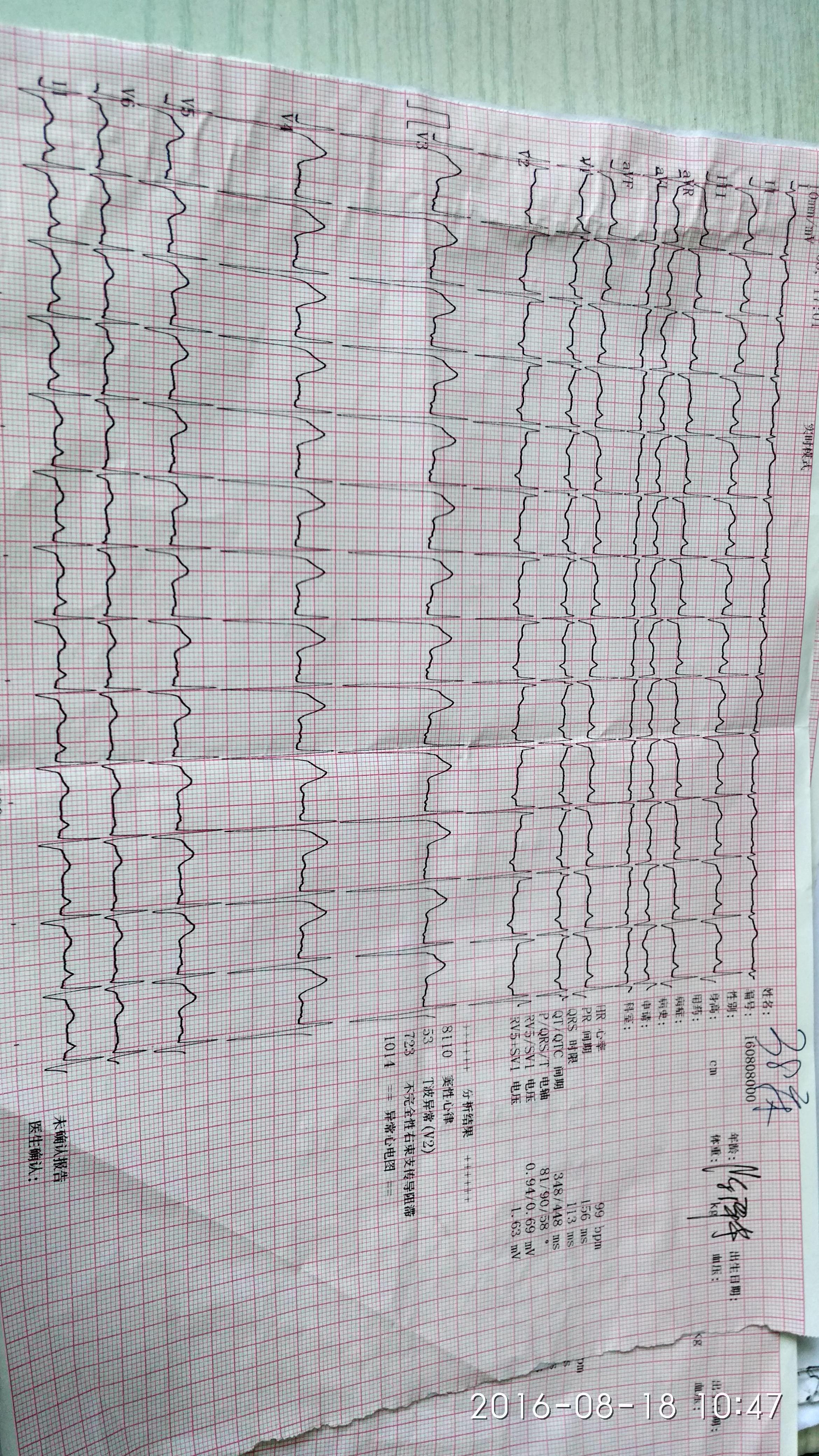 老师看下这份心电图v1v3的p波有异常