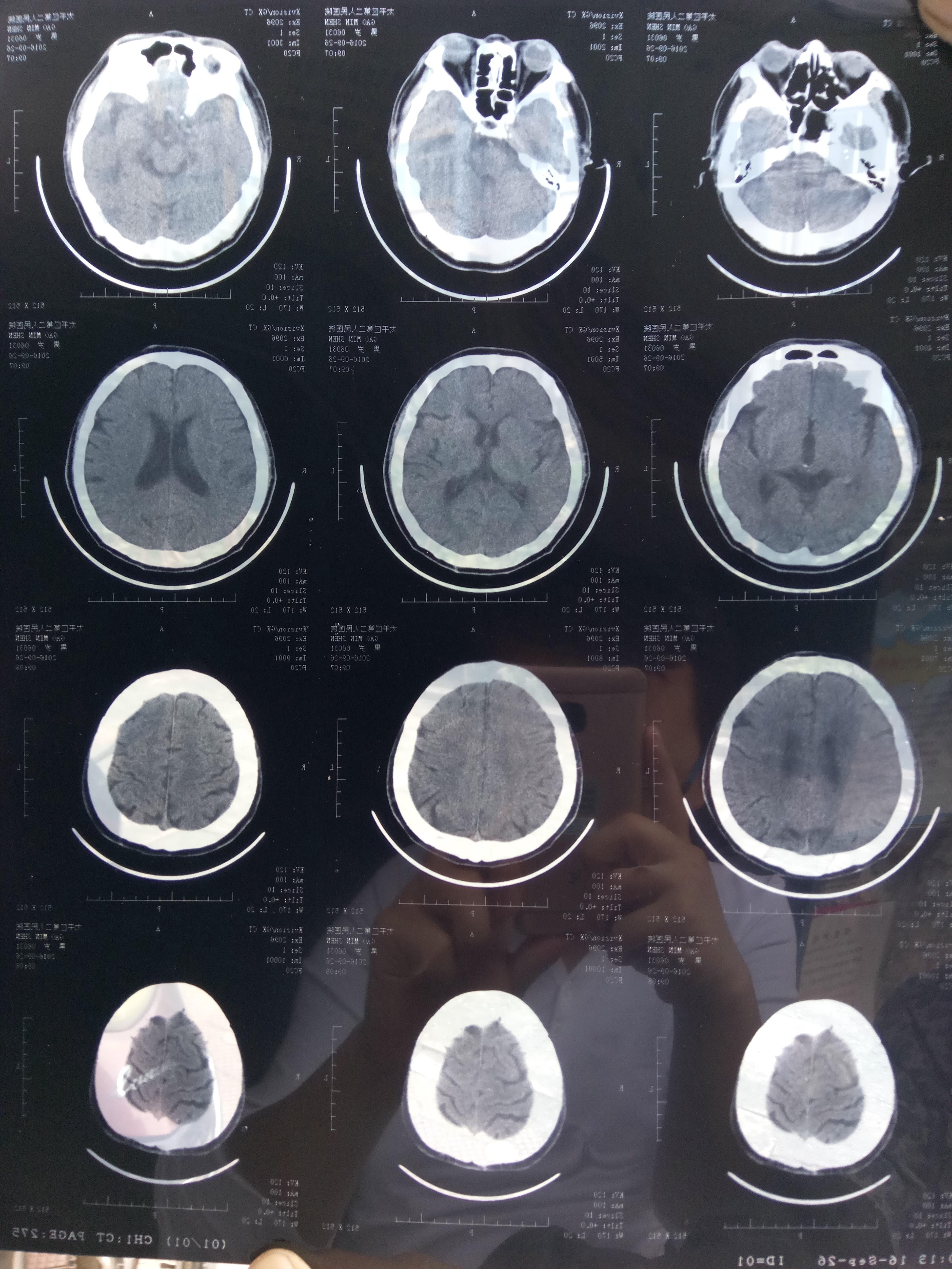 求助幫忙看腦ct片十分感謝好人一生平安