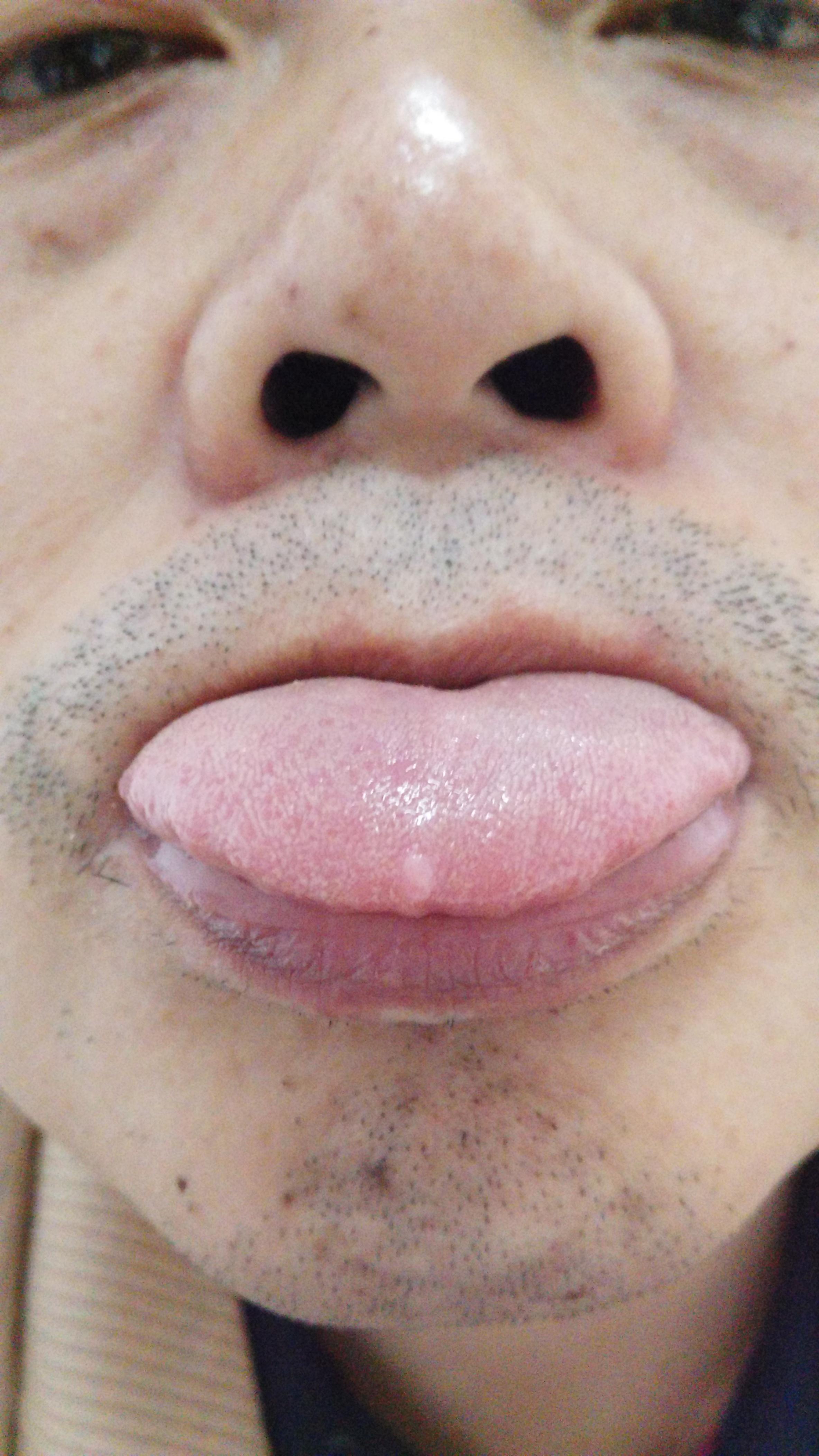 舌乳头 增生图片