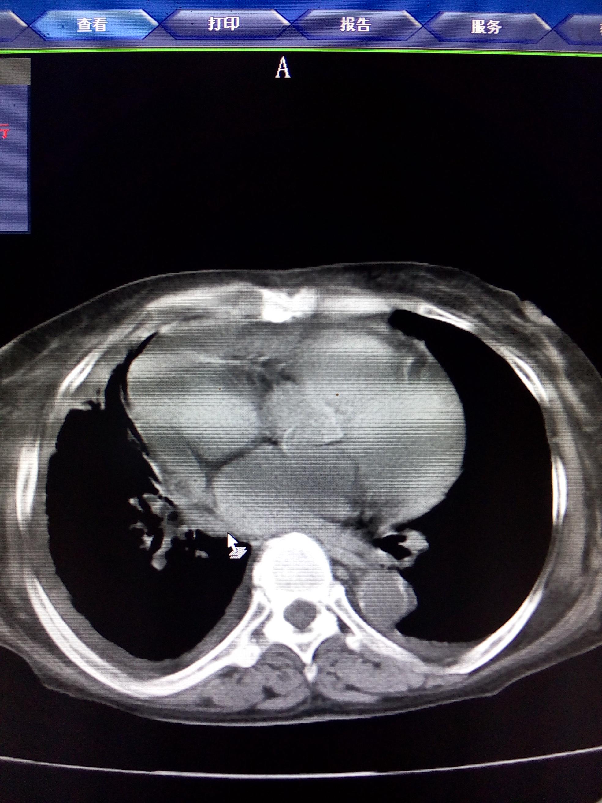 心包积液胸片图片