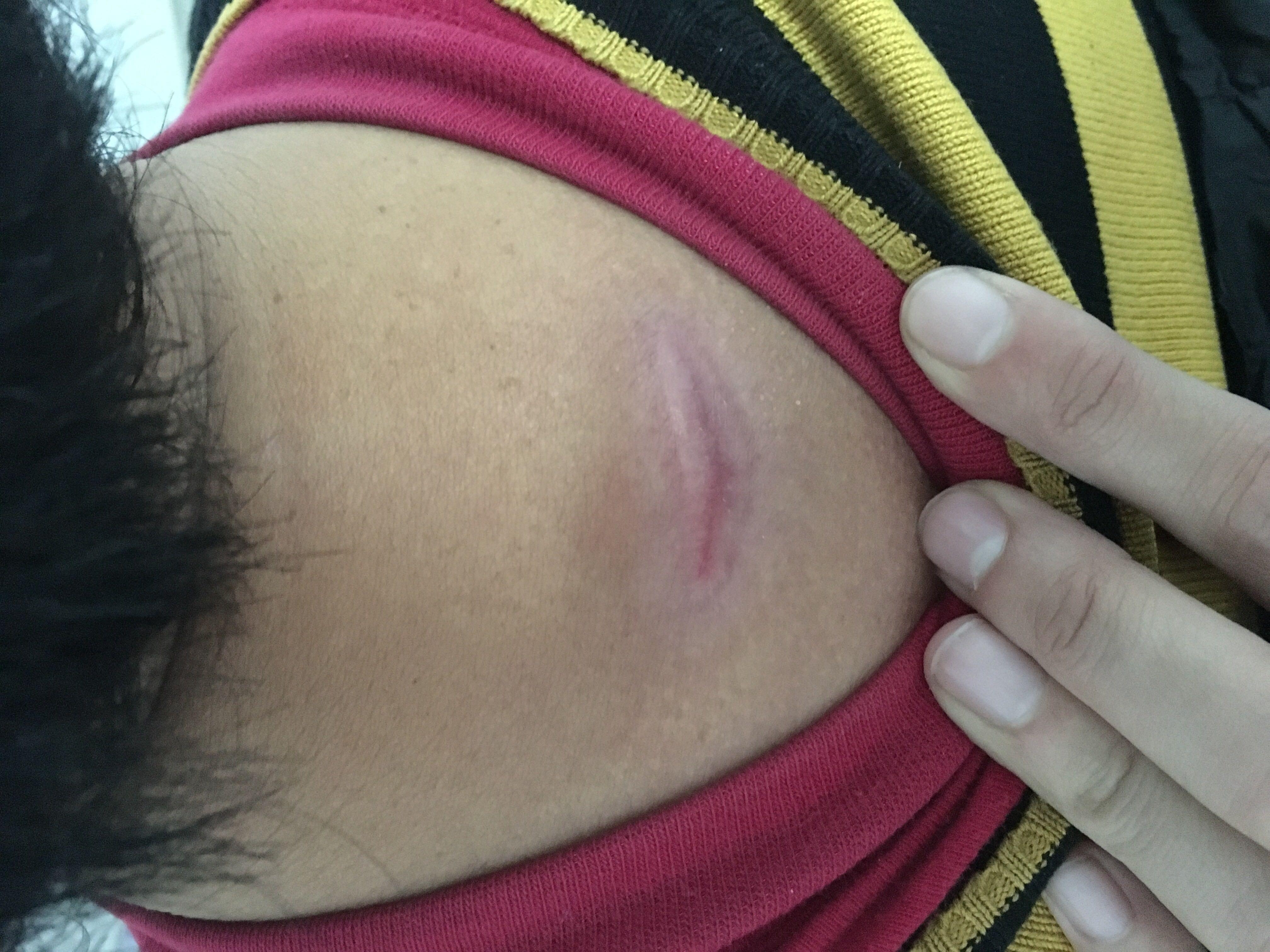 新生疤痕红色疼痛该如何解决