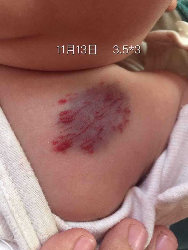 婴儿左上胸部圆形的红斑