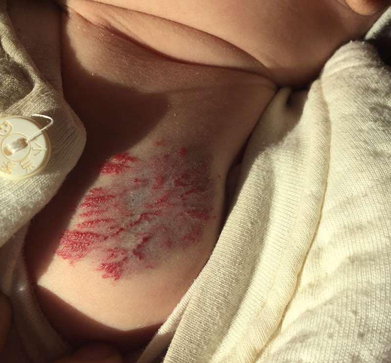婴儿左上胸部圆形的红斑