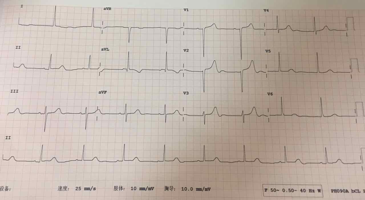 左心室肥大心电图图片