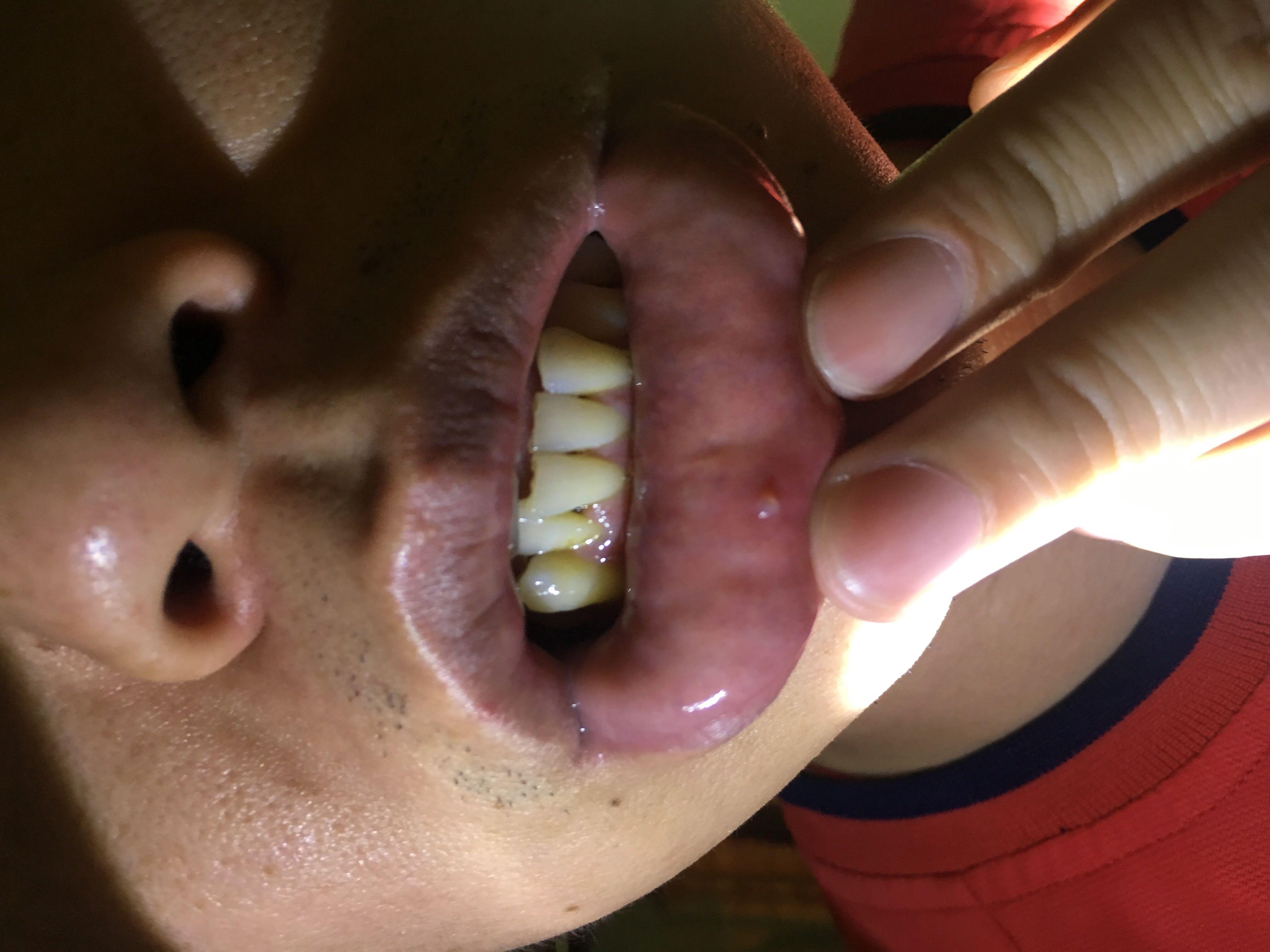 下唇小疙瘩比米粒略小不会增大