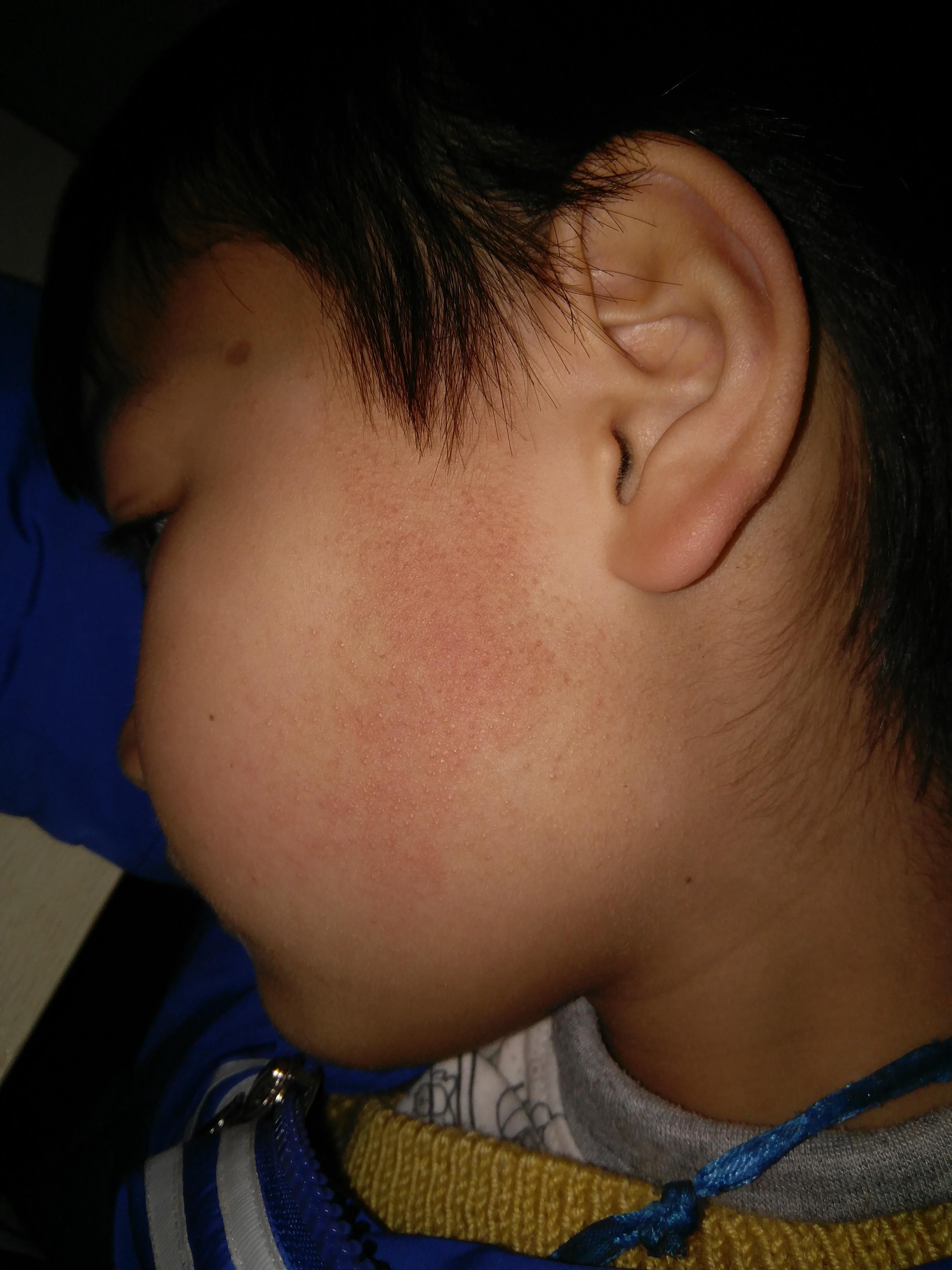 儿童8岁双侧面部皮肤泛发米粒样丘疹无痒痛感求诊断治疗