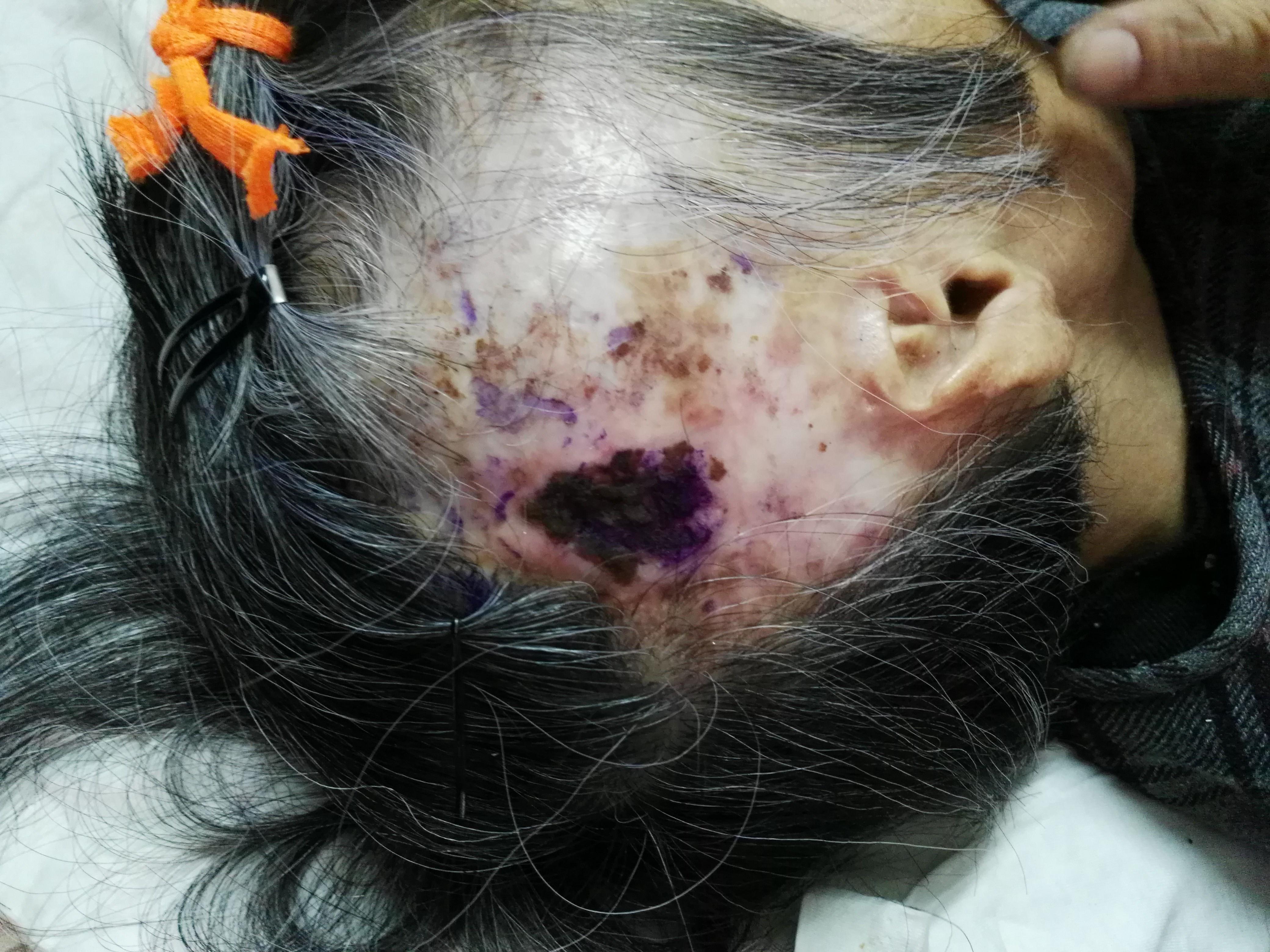 头部烧伤且骨缺损