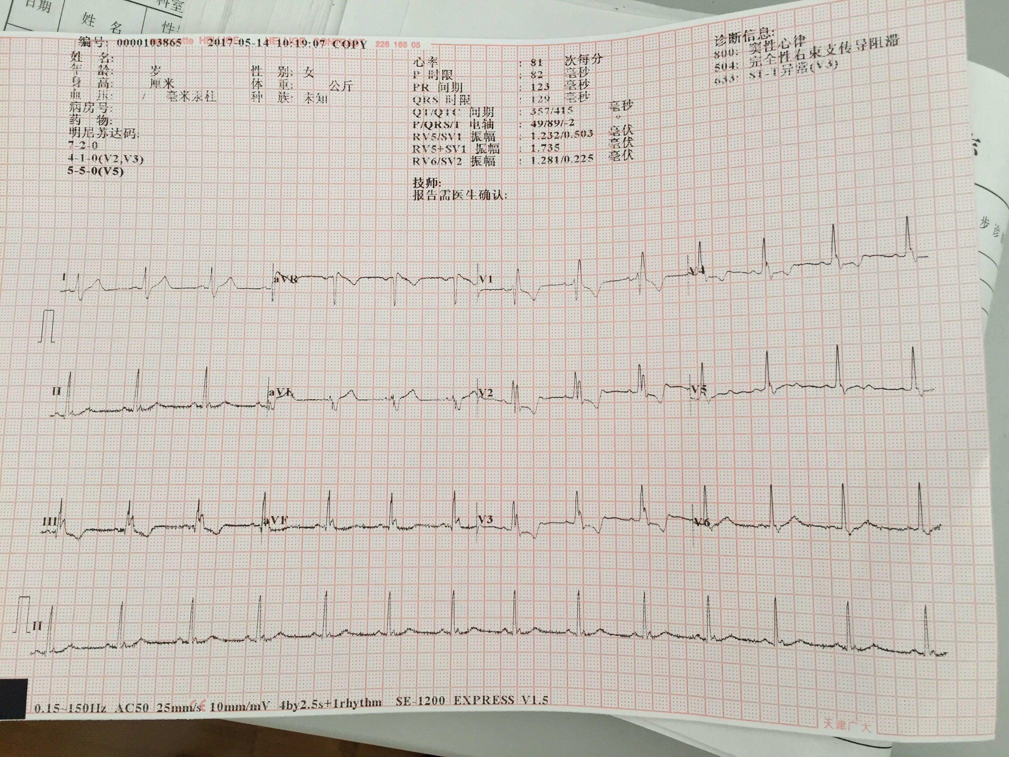 诊断学异常心电图图片