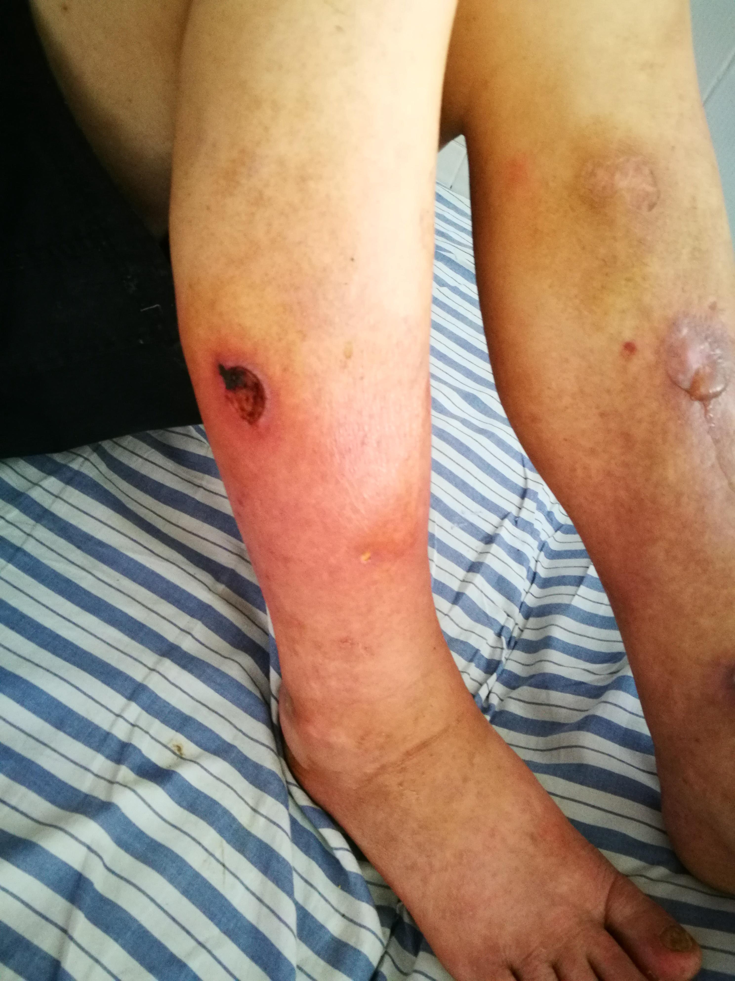 双下肢肿胀,散在多个溃疡 - 皮肤及性传播疾病讨论版 - 爱爱医医学