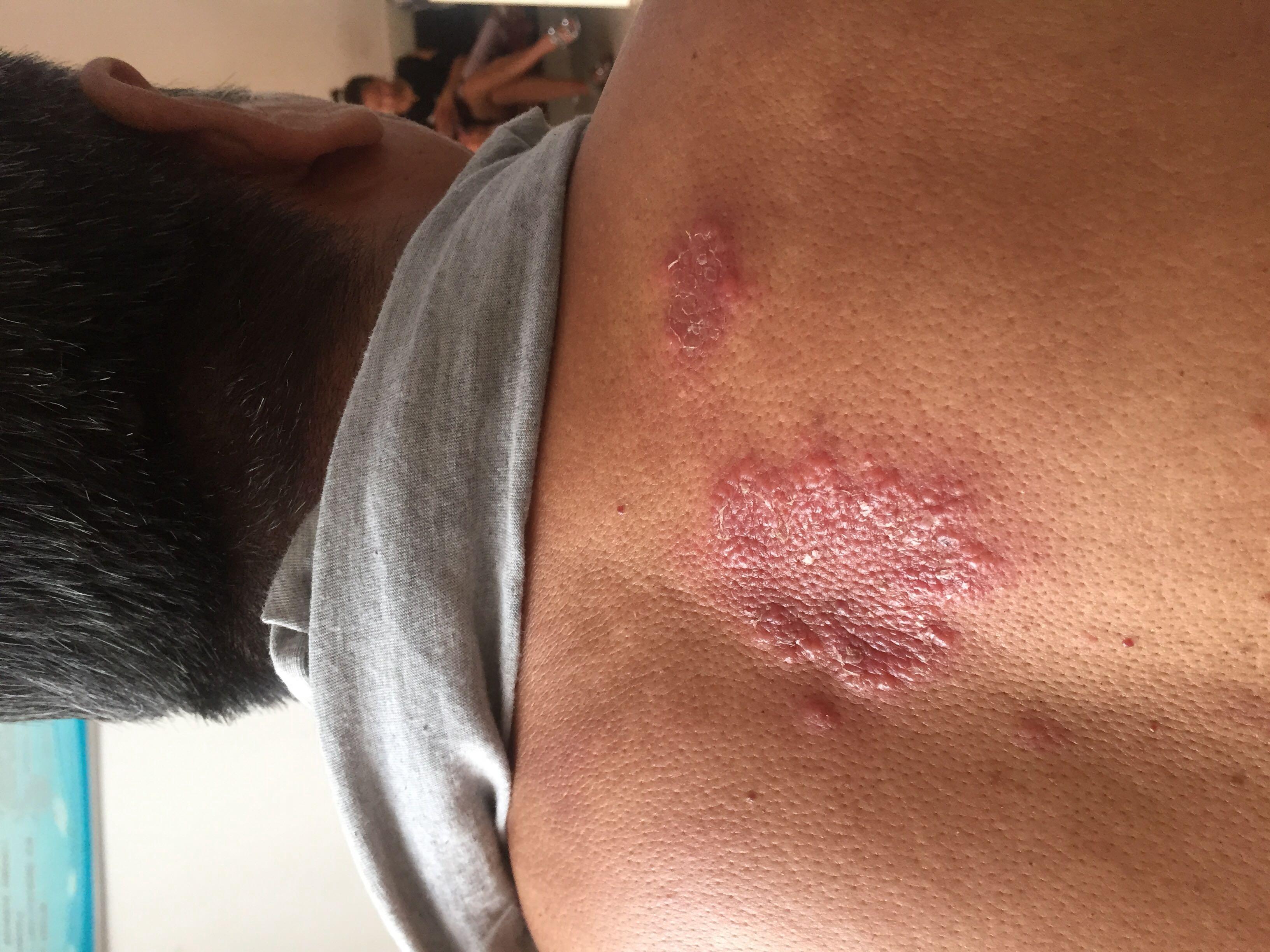 大家帮忙看看是单纯疱疹吗