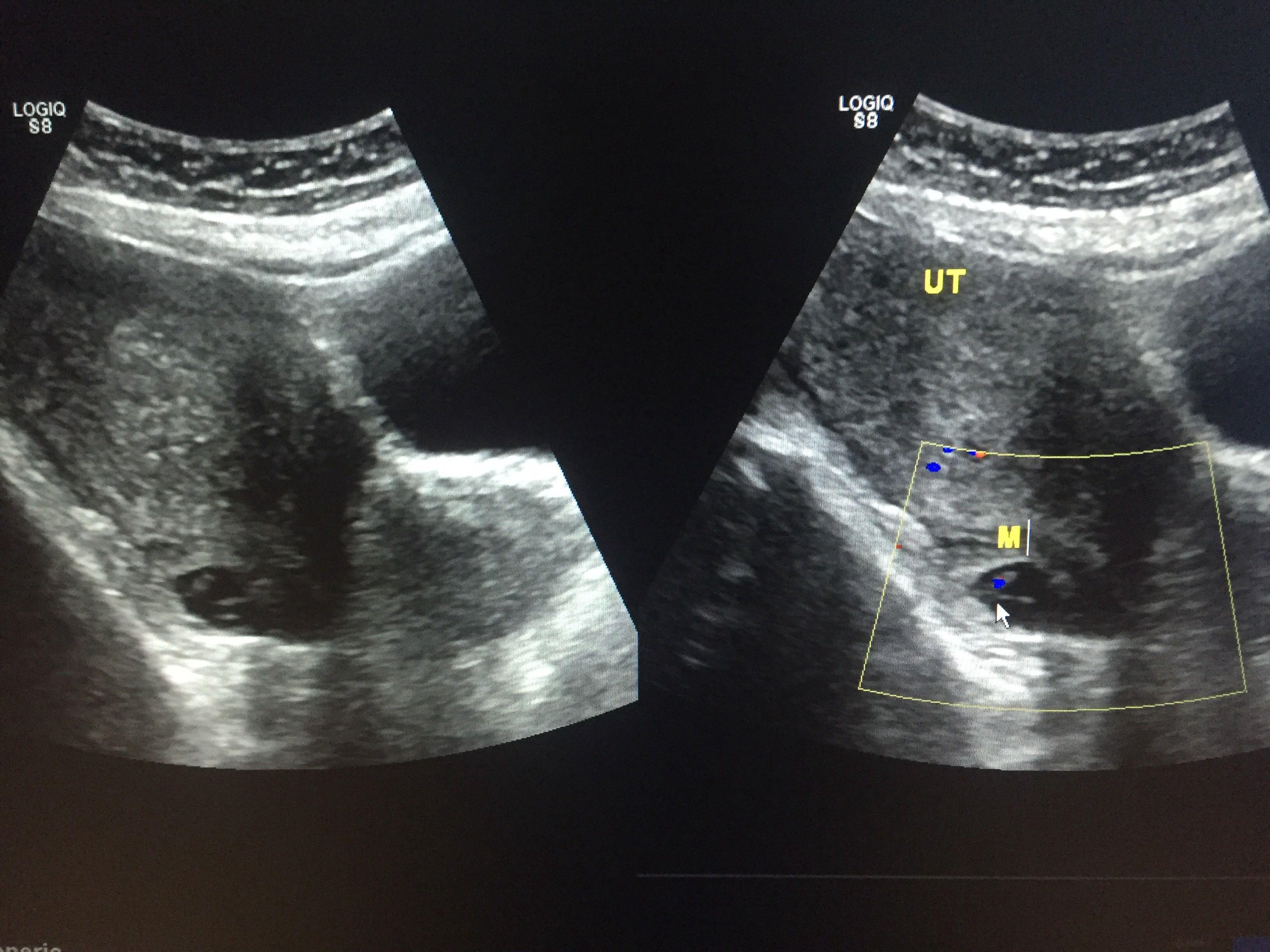 异位妊娠超声图片