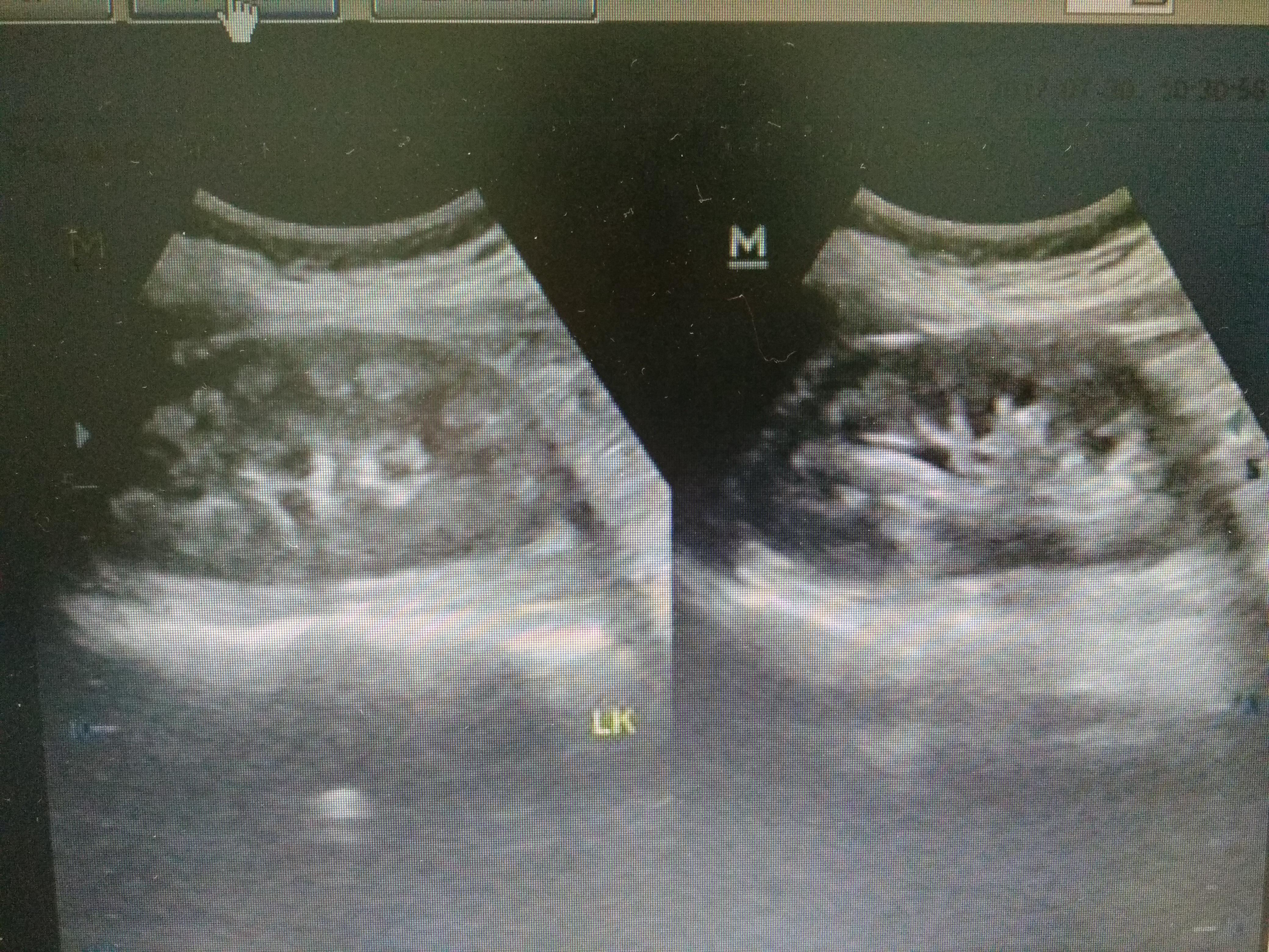这个是海绵肾?可以诊断吗 - 超声医学讨论版 - 爱爱医医学论坛