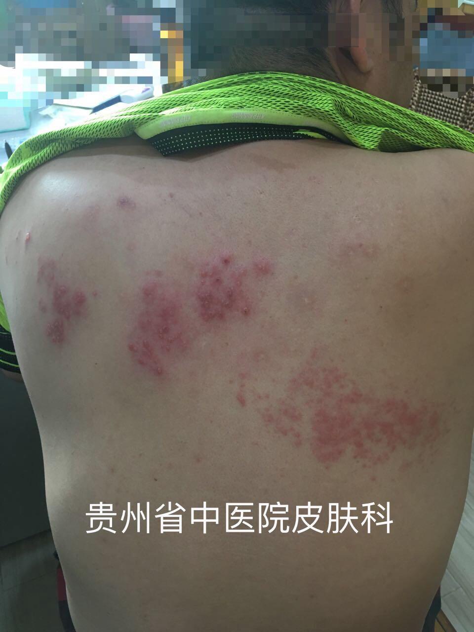 典型皮损你见过多少双侧疱疹