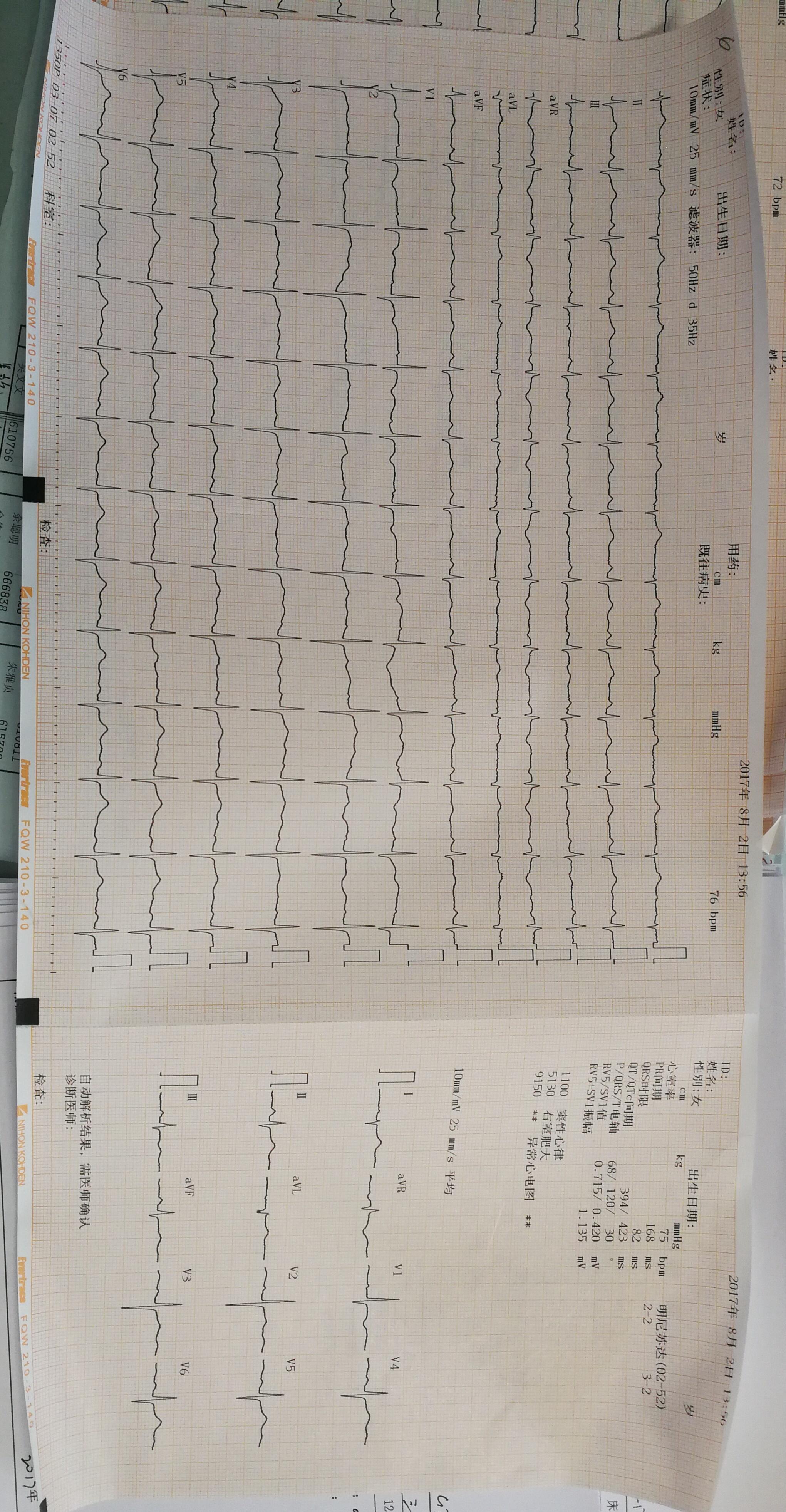心衰的心电图诊断标准图片