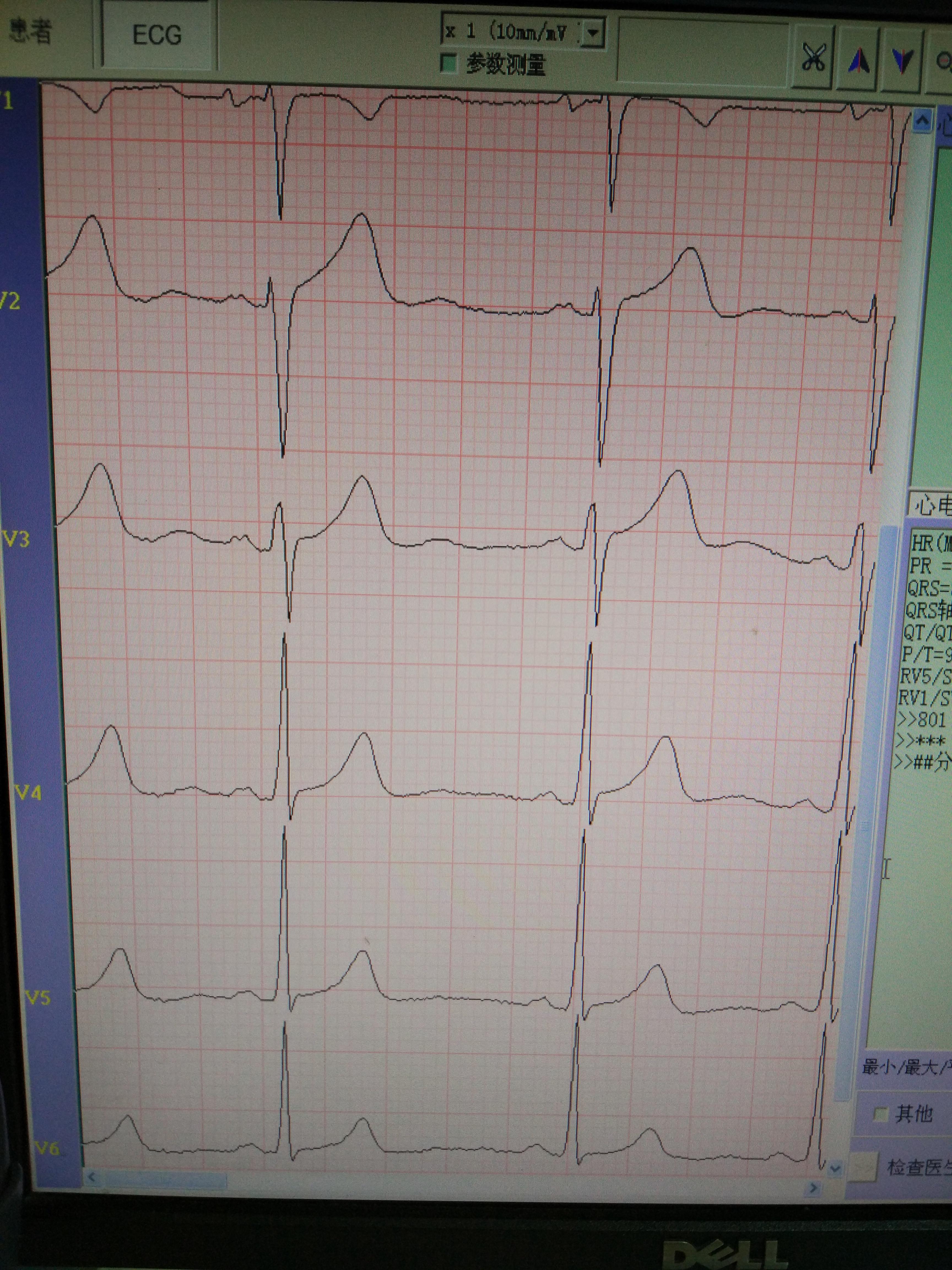 心電圖腦電圖專業討論版 - 愛愛醫醫學論壇