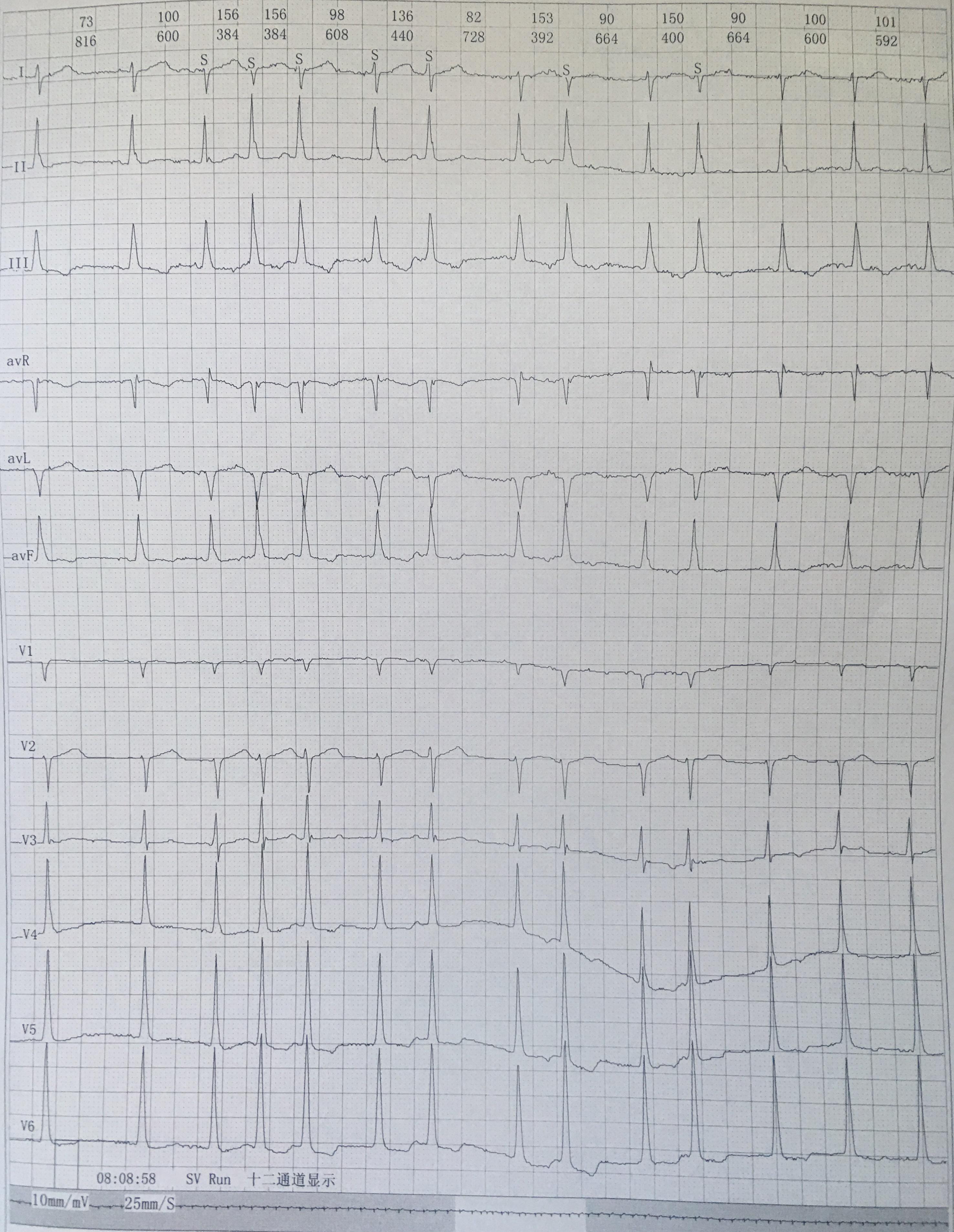 短阵房速心电图图片图片