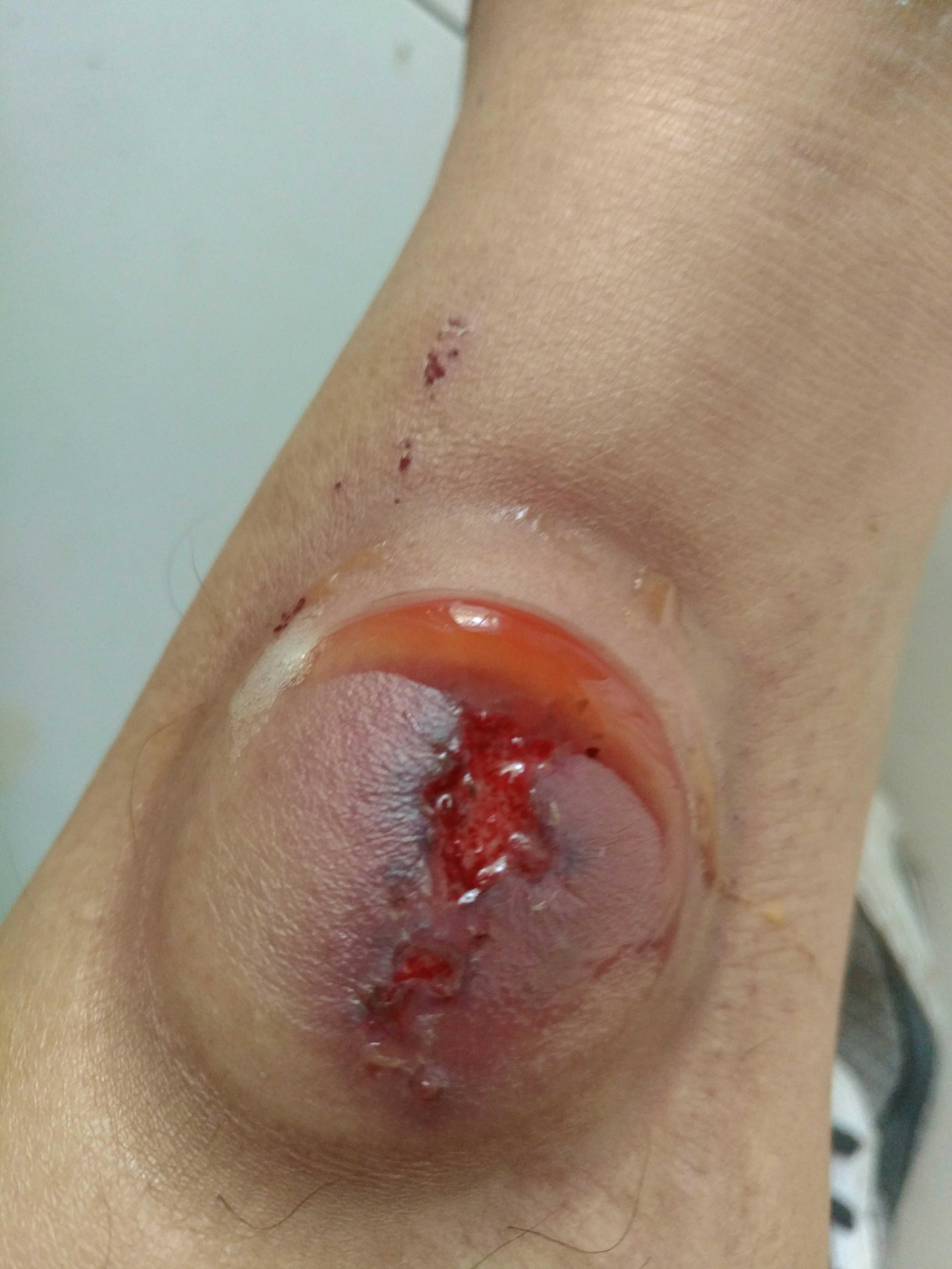 发炎结痂了还痒处理图片