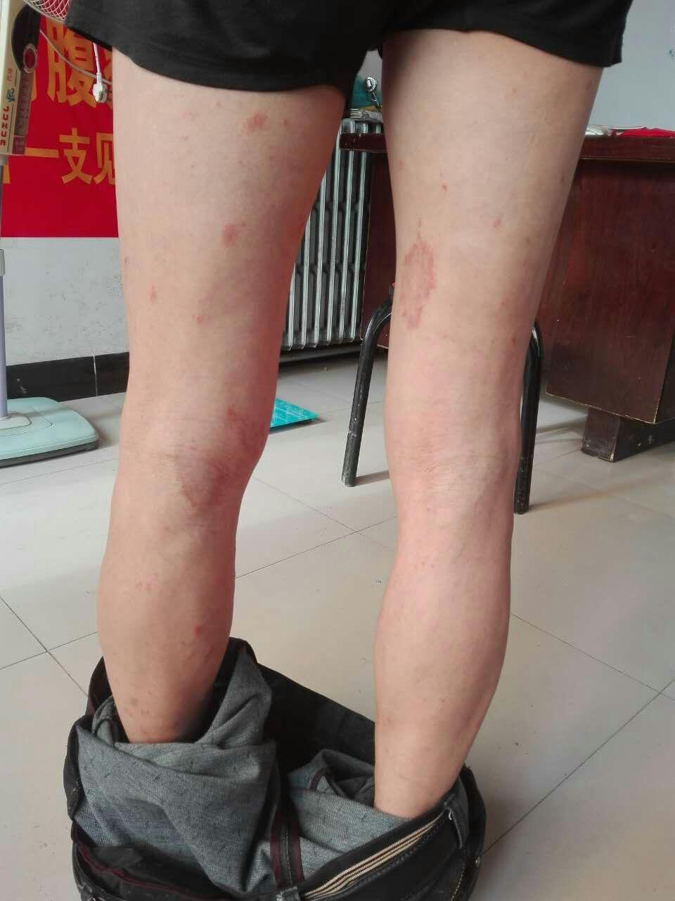 版网互动精彩病例展示一12看图诊病转帖玫瑰糠疹