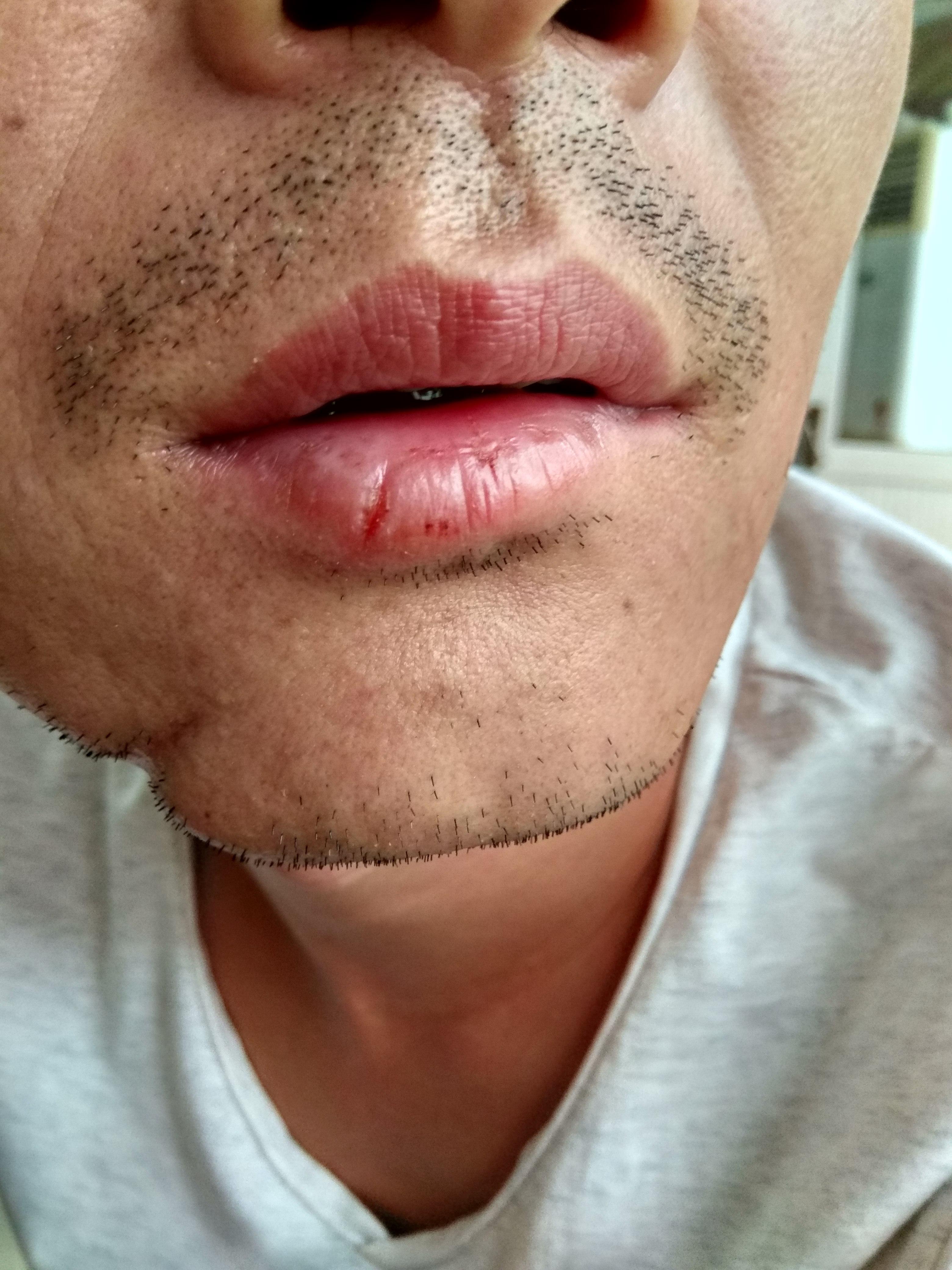 皮肤病下口唇干裂