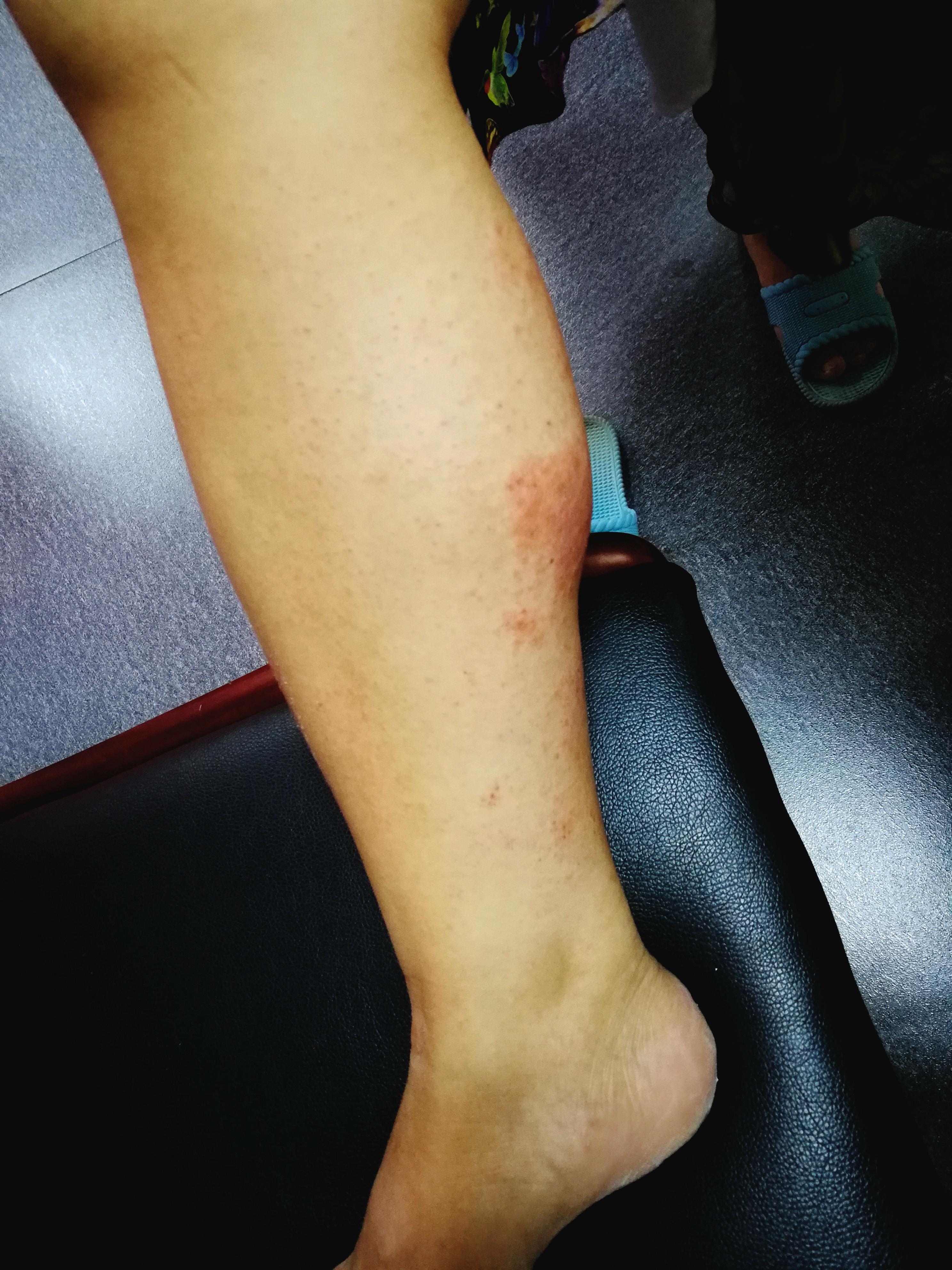 双下肢皮疹,伴瘙痒一周 - 皮肤及性传播疾病讨论版 - 爱爱医医学论坛