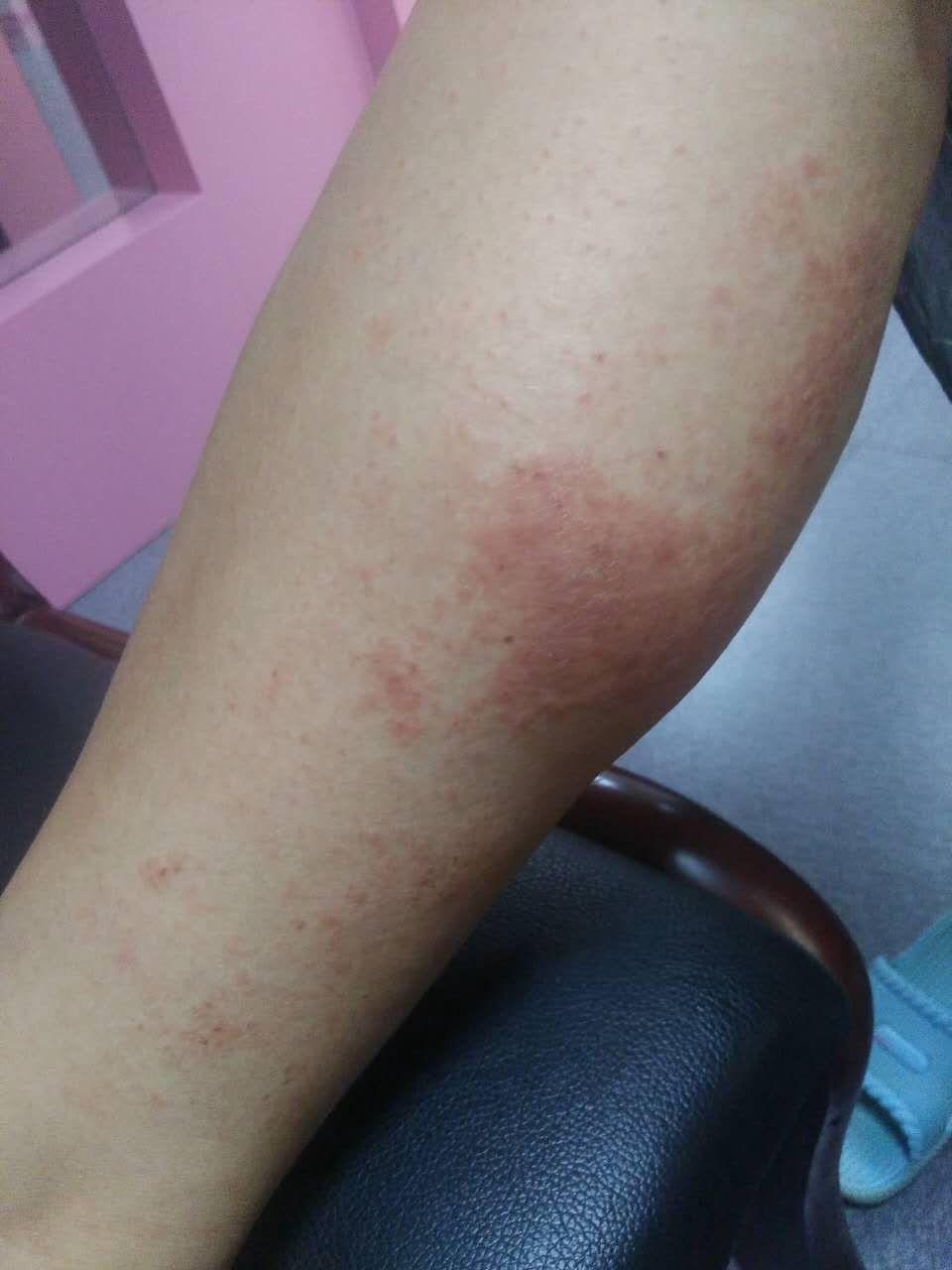 双下肢皮疹伴瘙痒一周