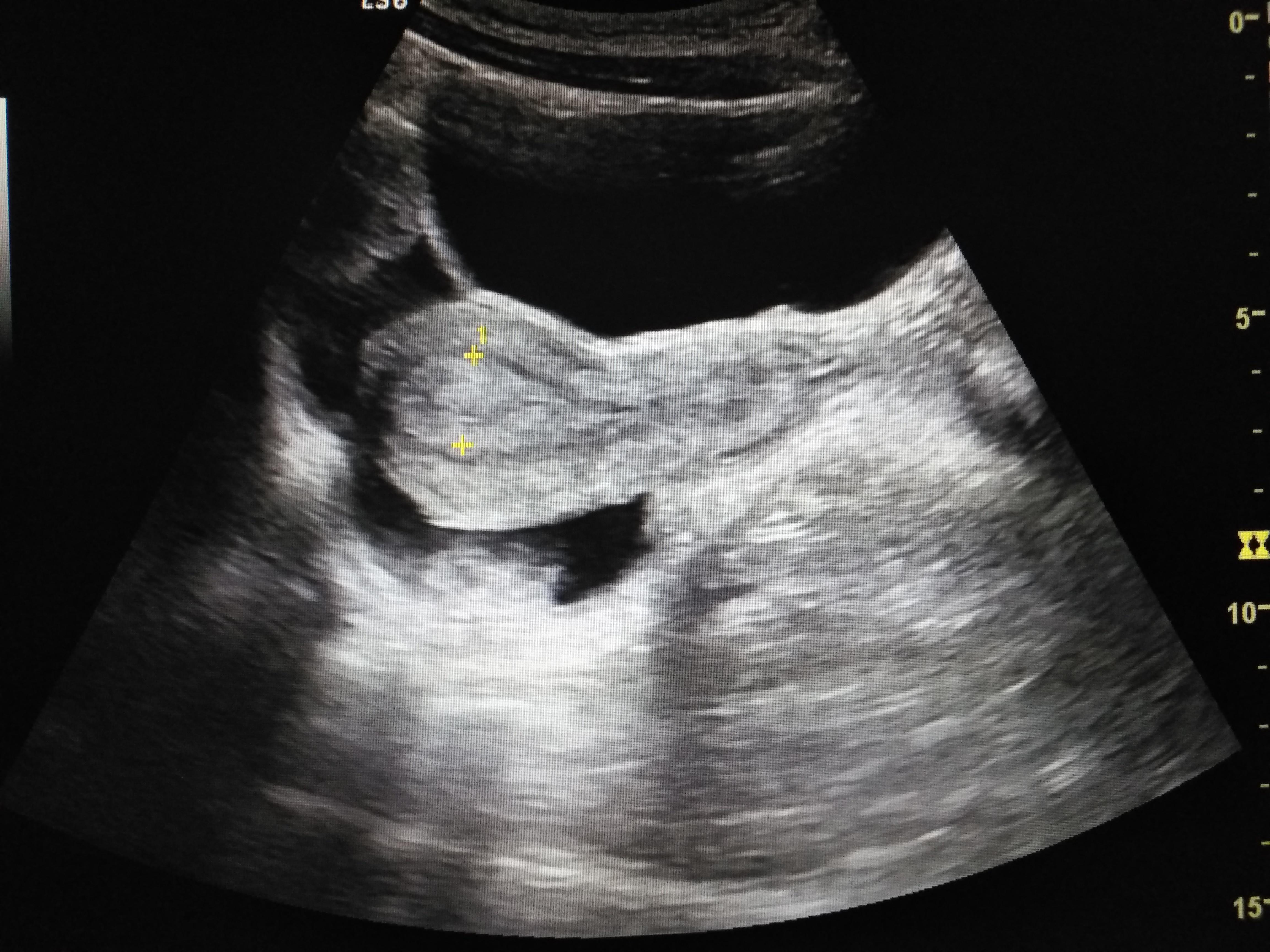 请教子宫及双附件超声检查