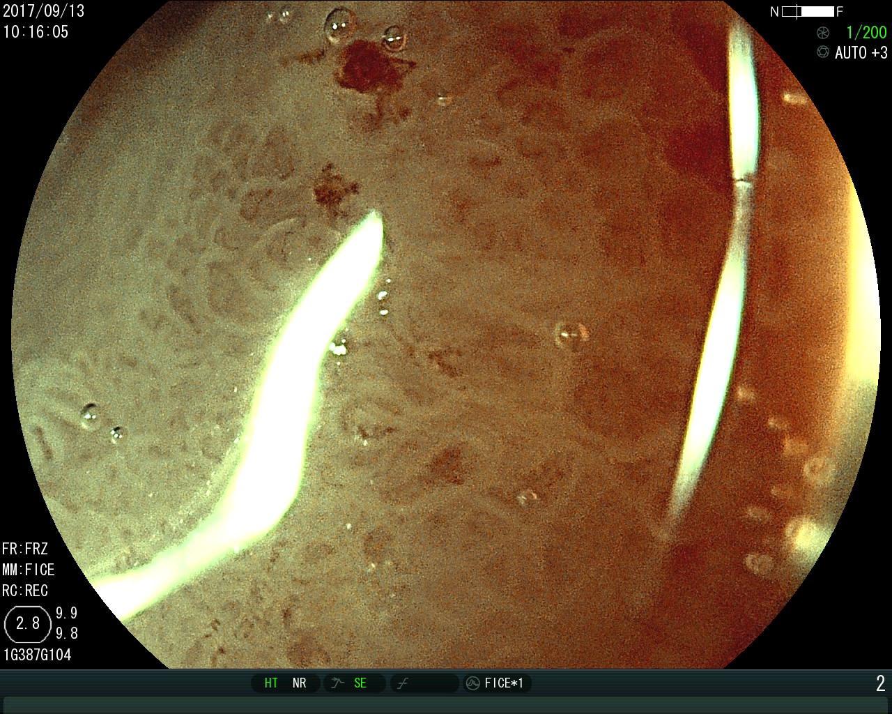 早期胃癌的放大胃镜图片