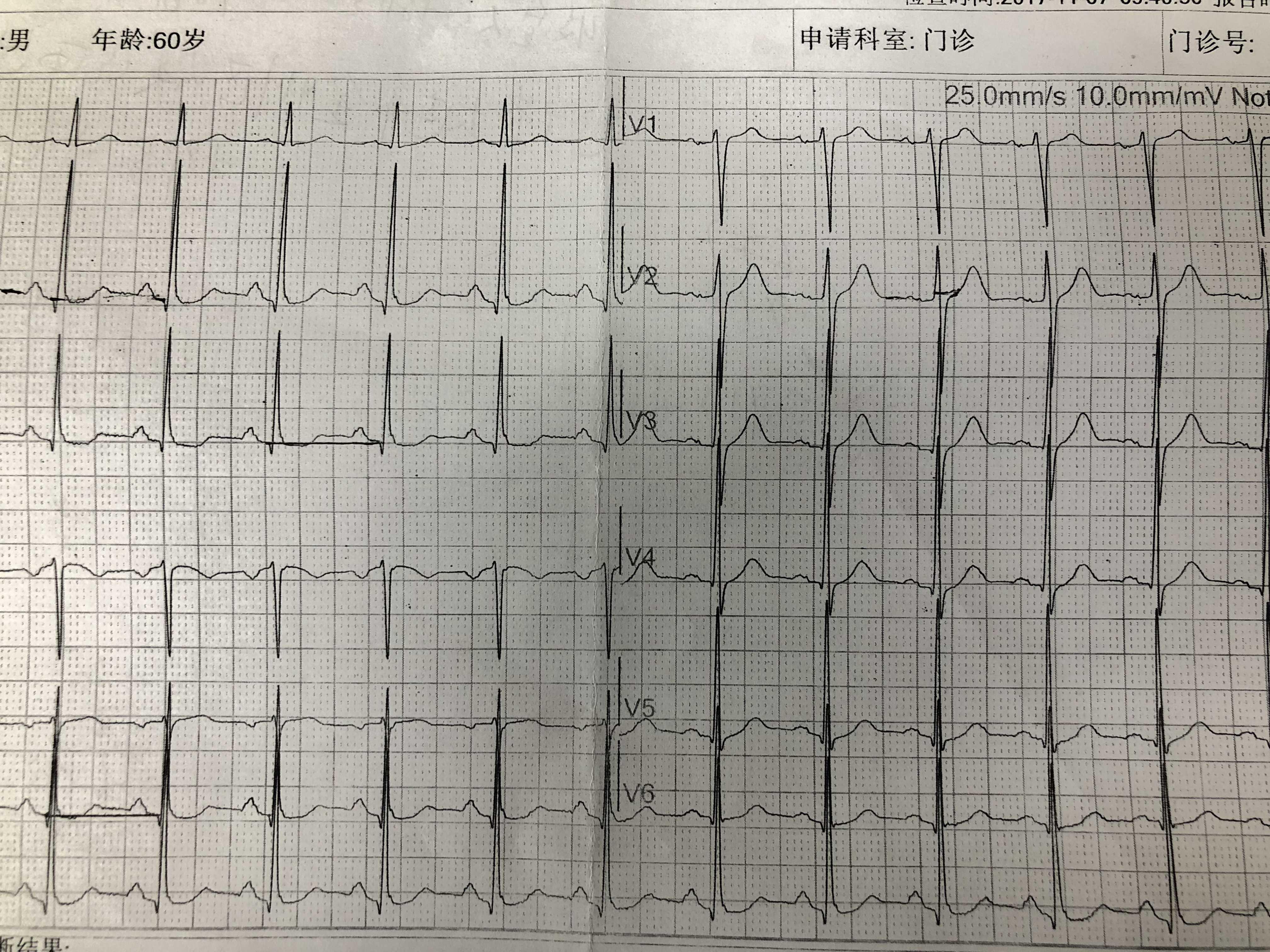 心电图胸导联低电压图片