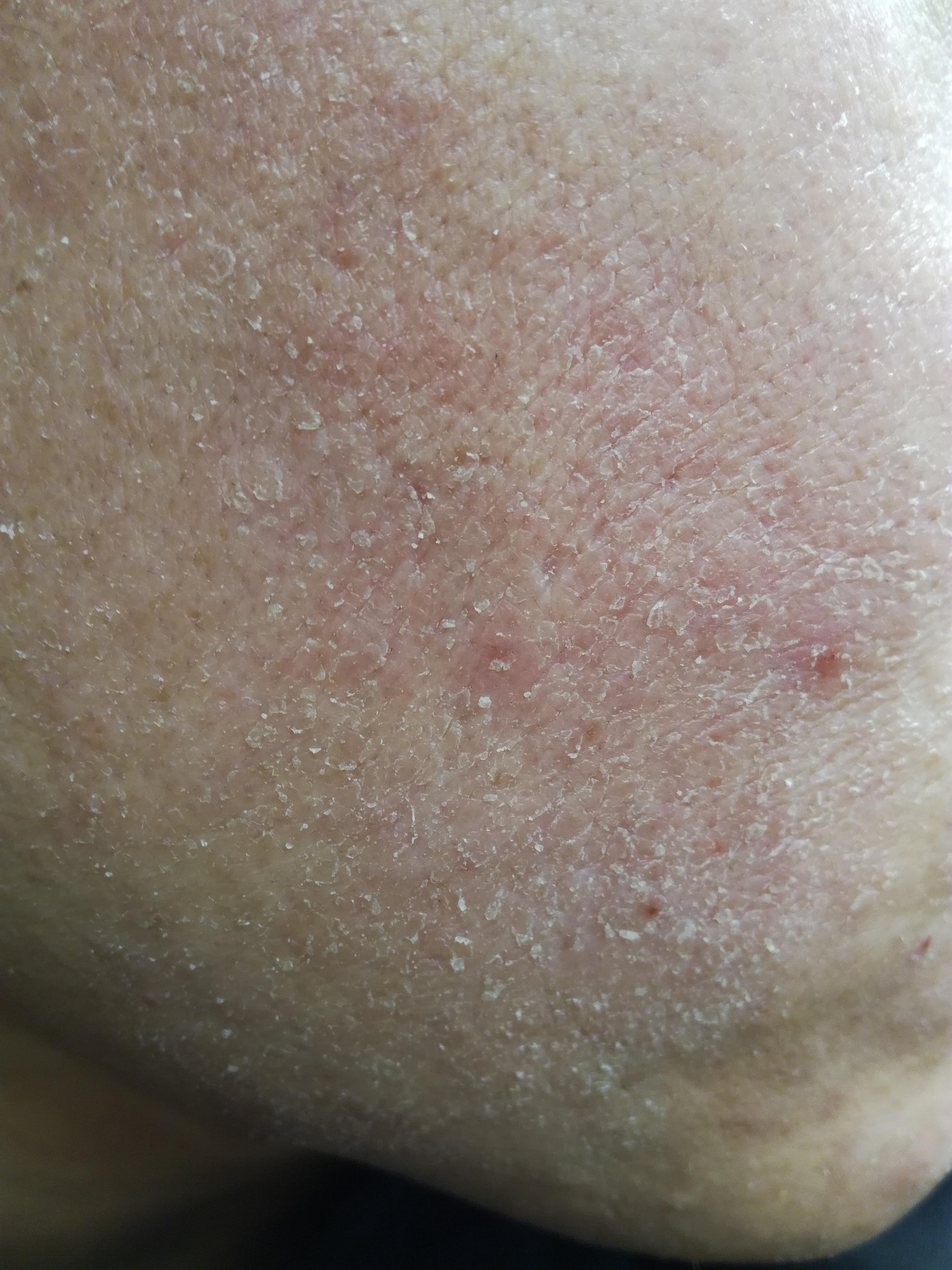 脸上痒起皮头皮屑多