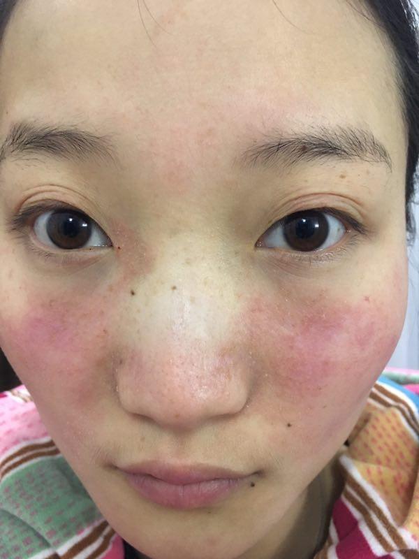 面部湿疹患病10个多月