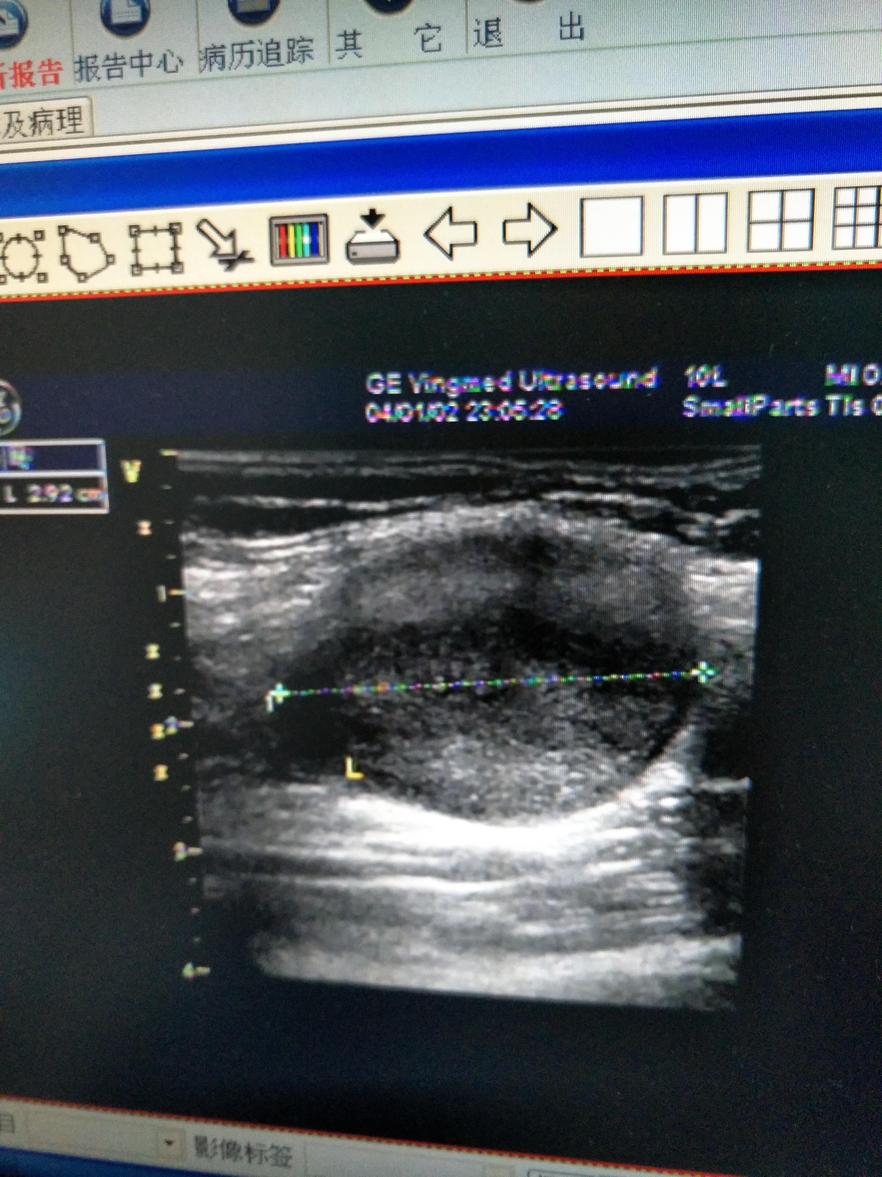 左侧腋窝包块怎么诊断