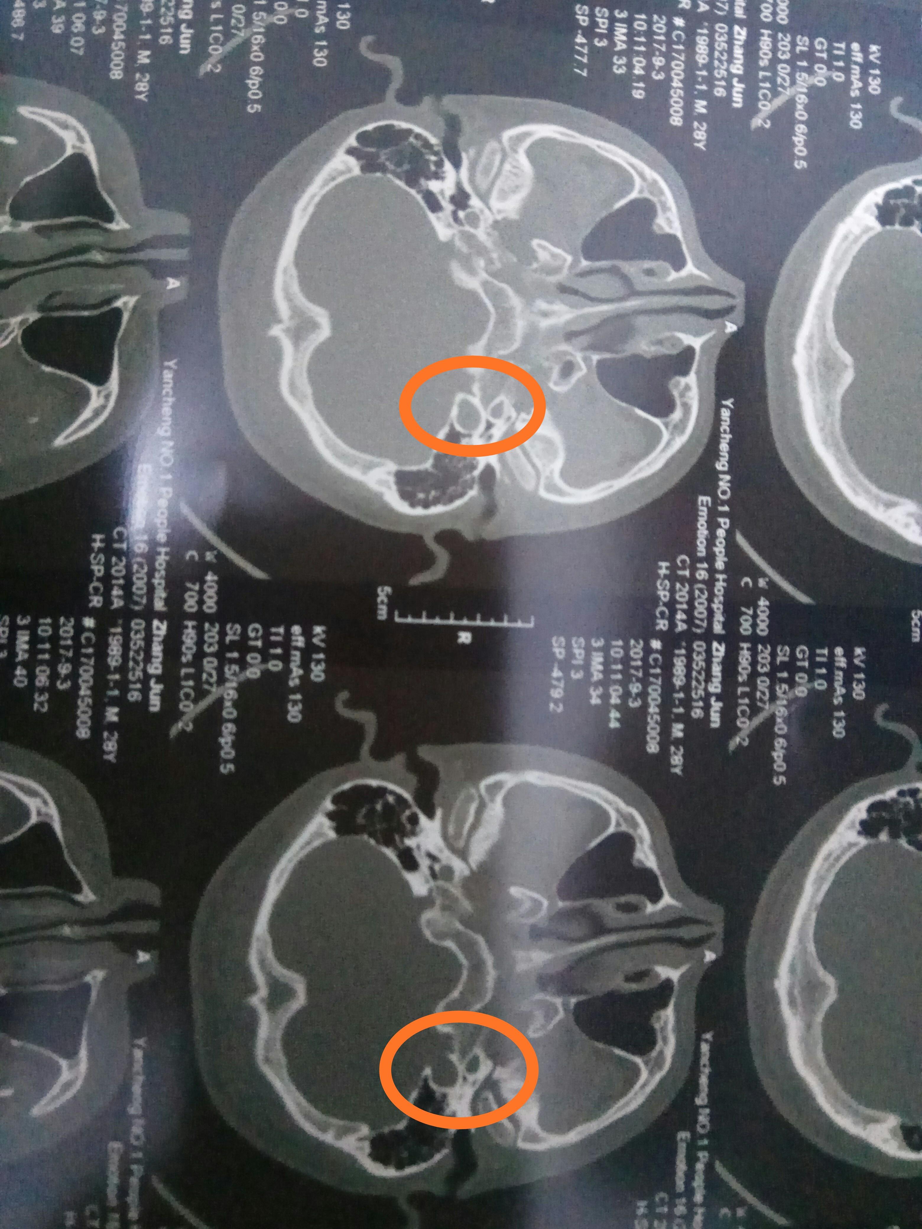 病例18颈静脉球窝高位