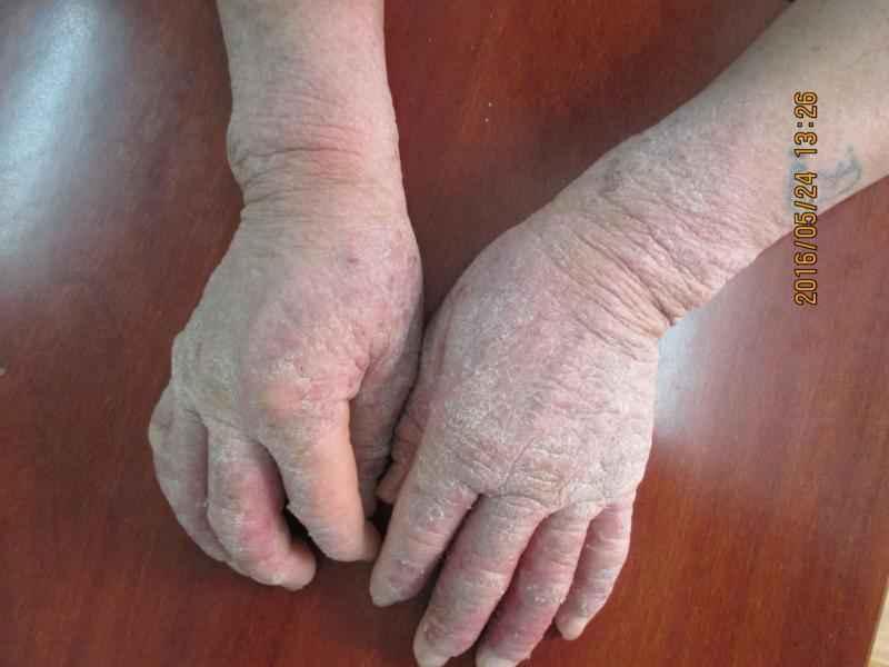 手癣还是什么请各位医生看看