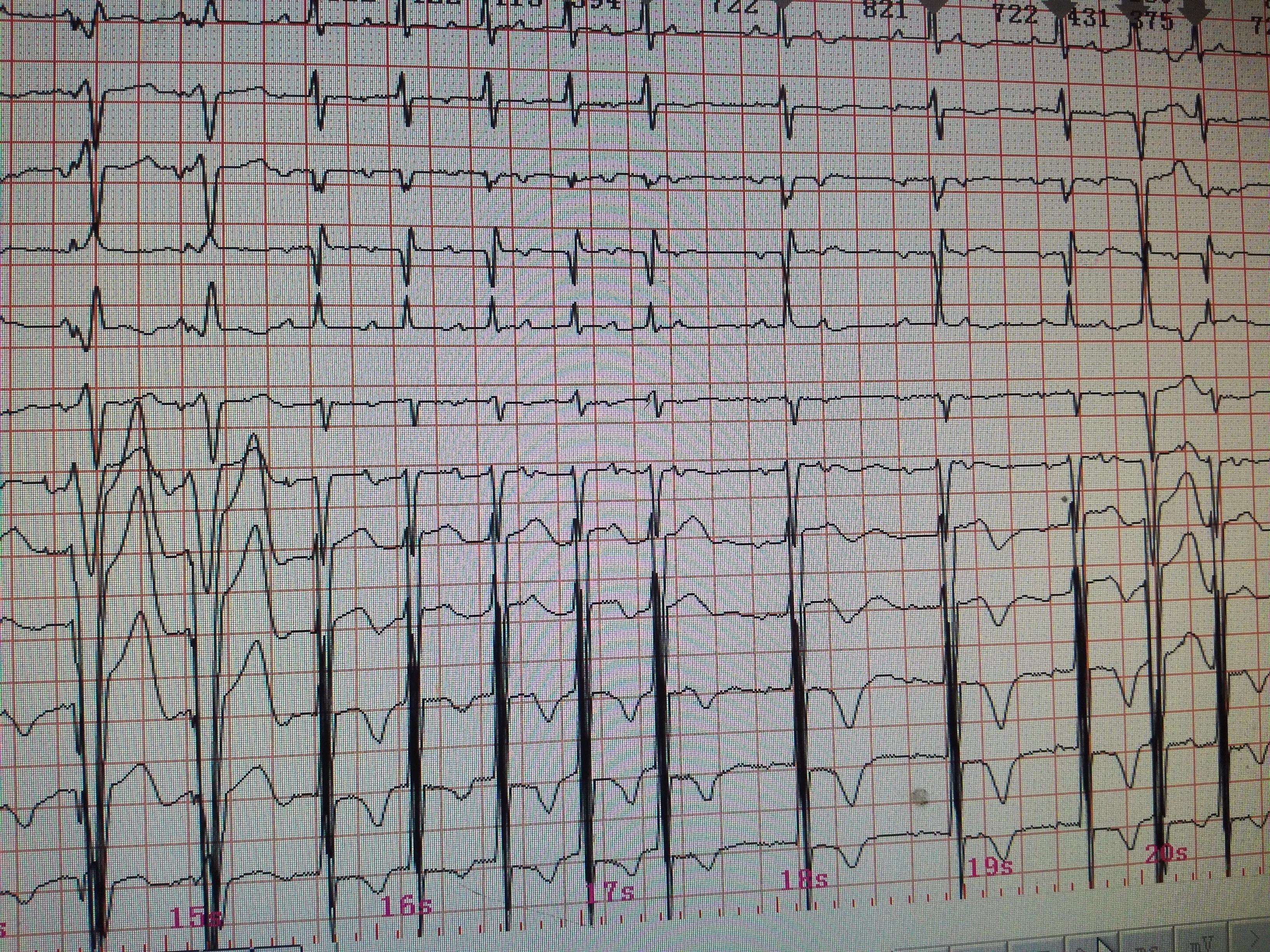 心脏起搏器心电图波形图片