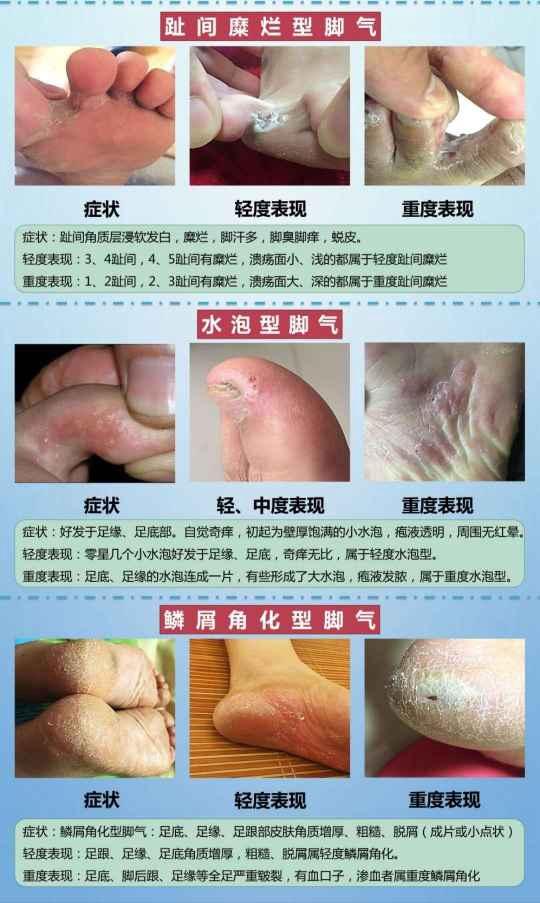 脚气灰指甲体癣股癣治疗病例持续分享与各位同仁共勉