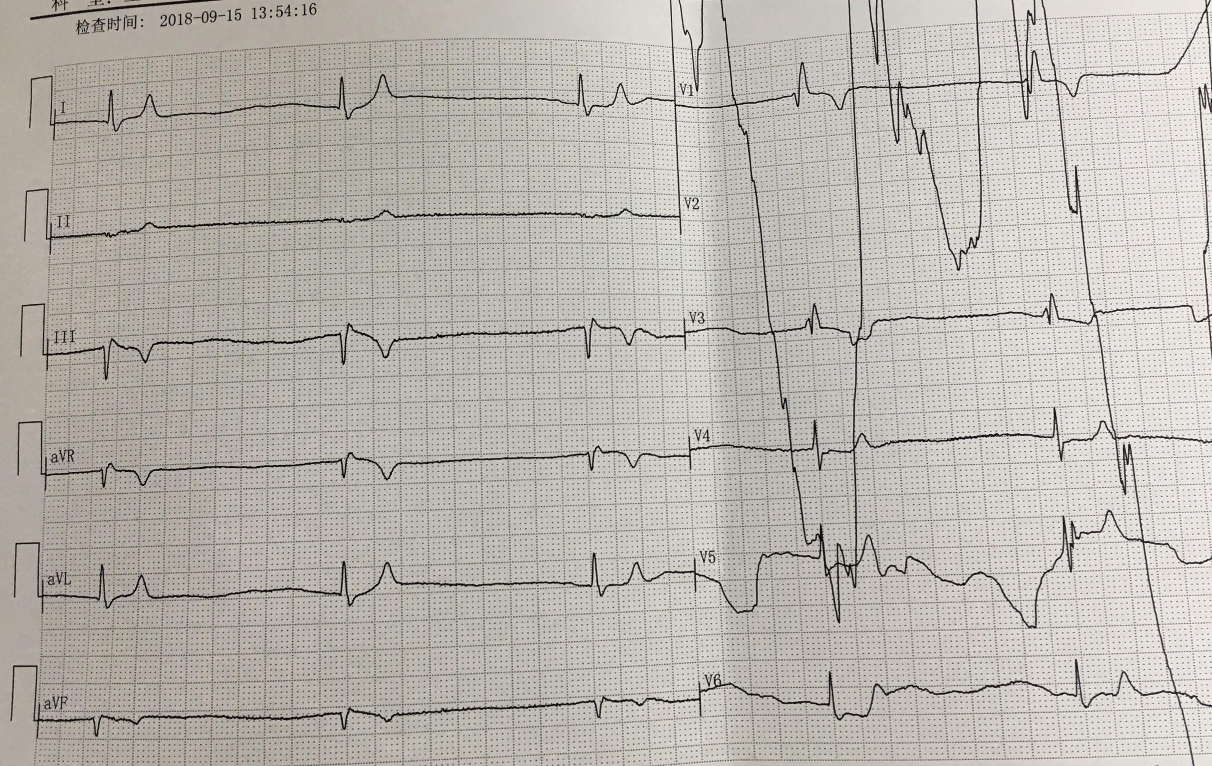 房顫遇到高血鉀的心電圖