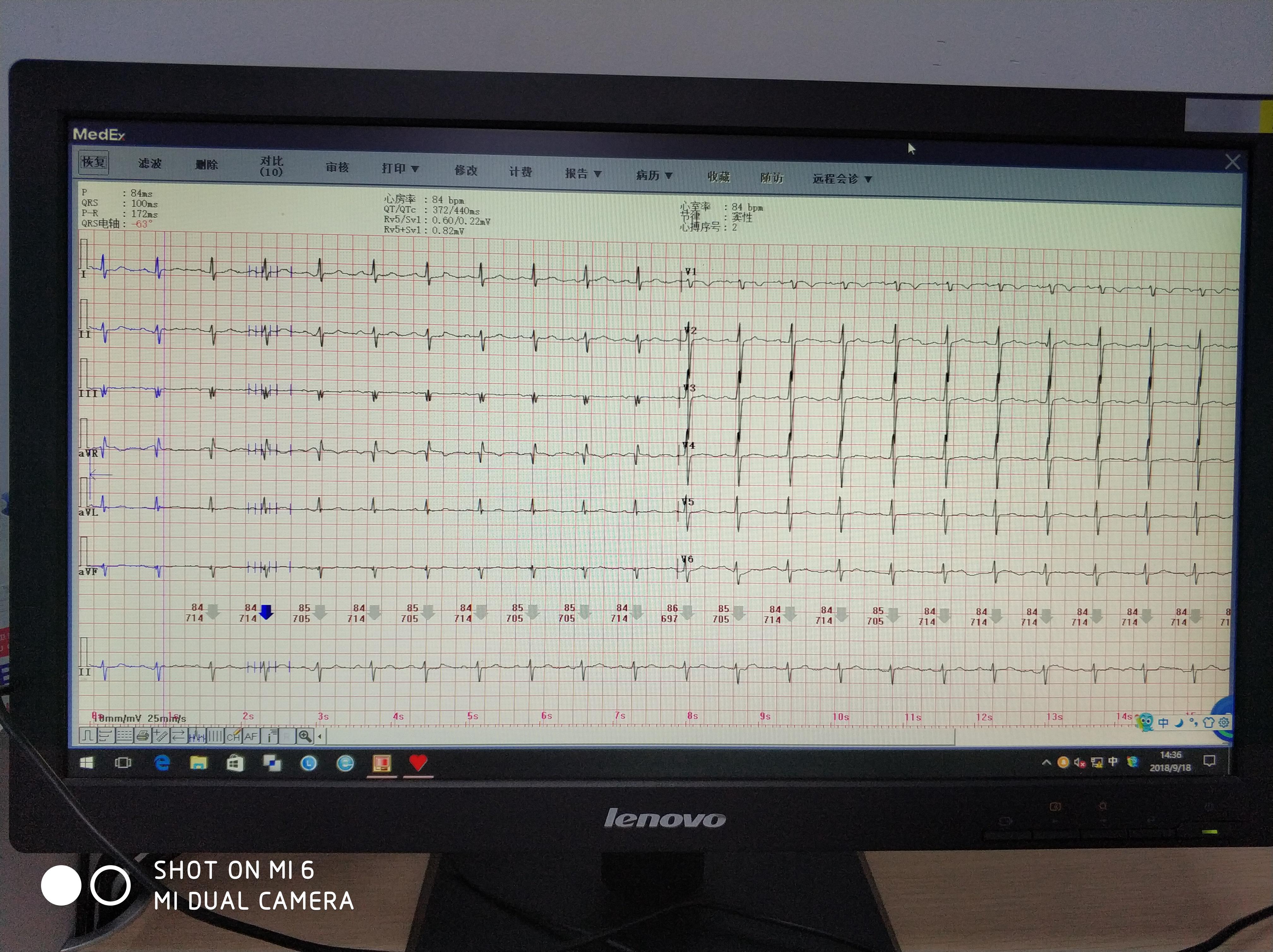 老师们,请教一下胸导联r波上升不良的问题 - 心电图脑电图专业讨论版