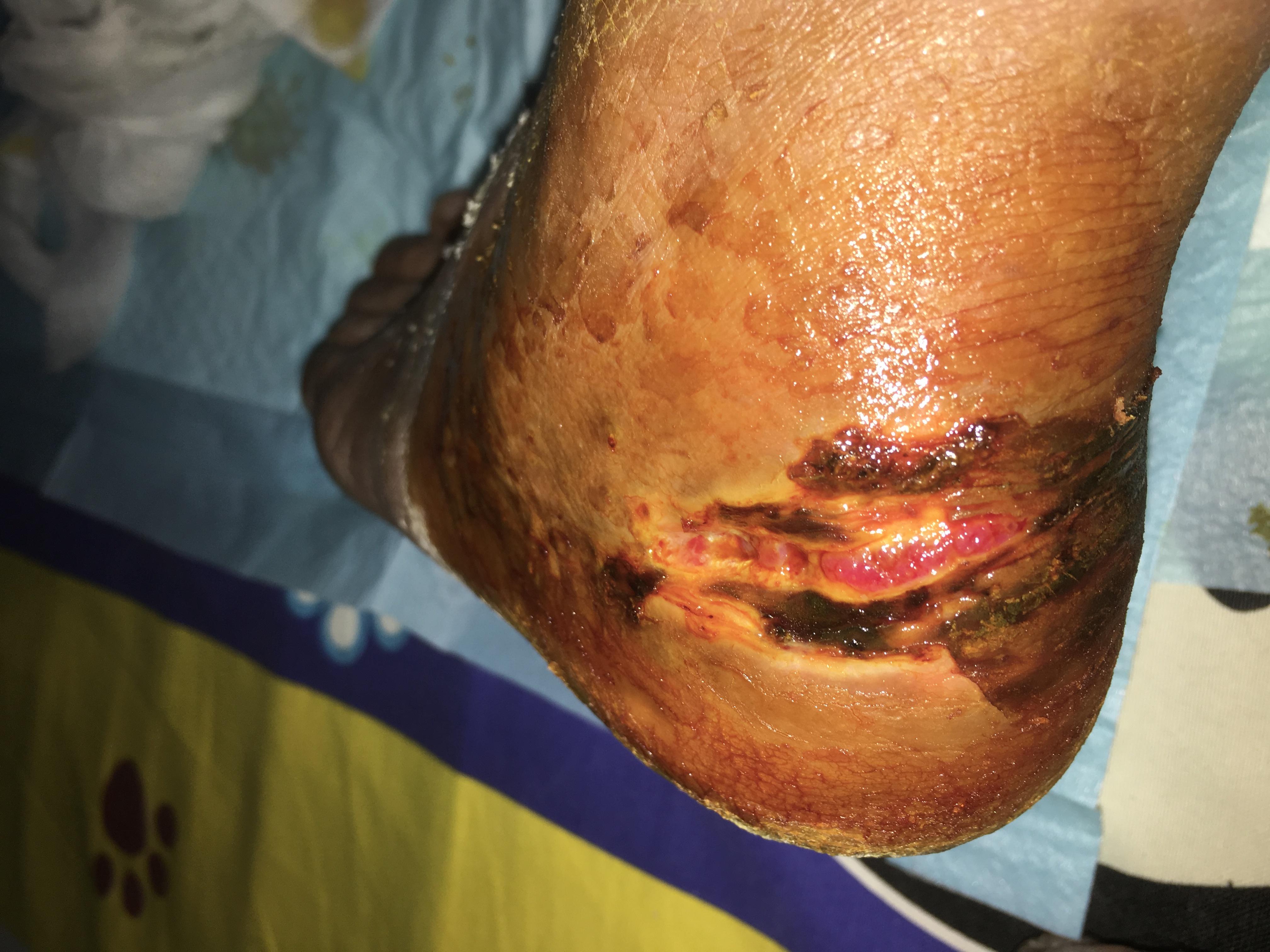 跟骨骨折术后100天刀口不愈合