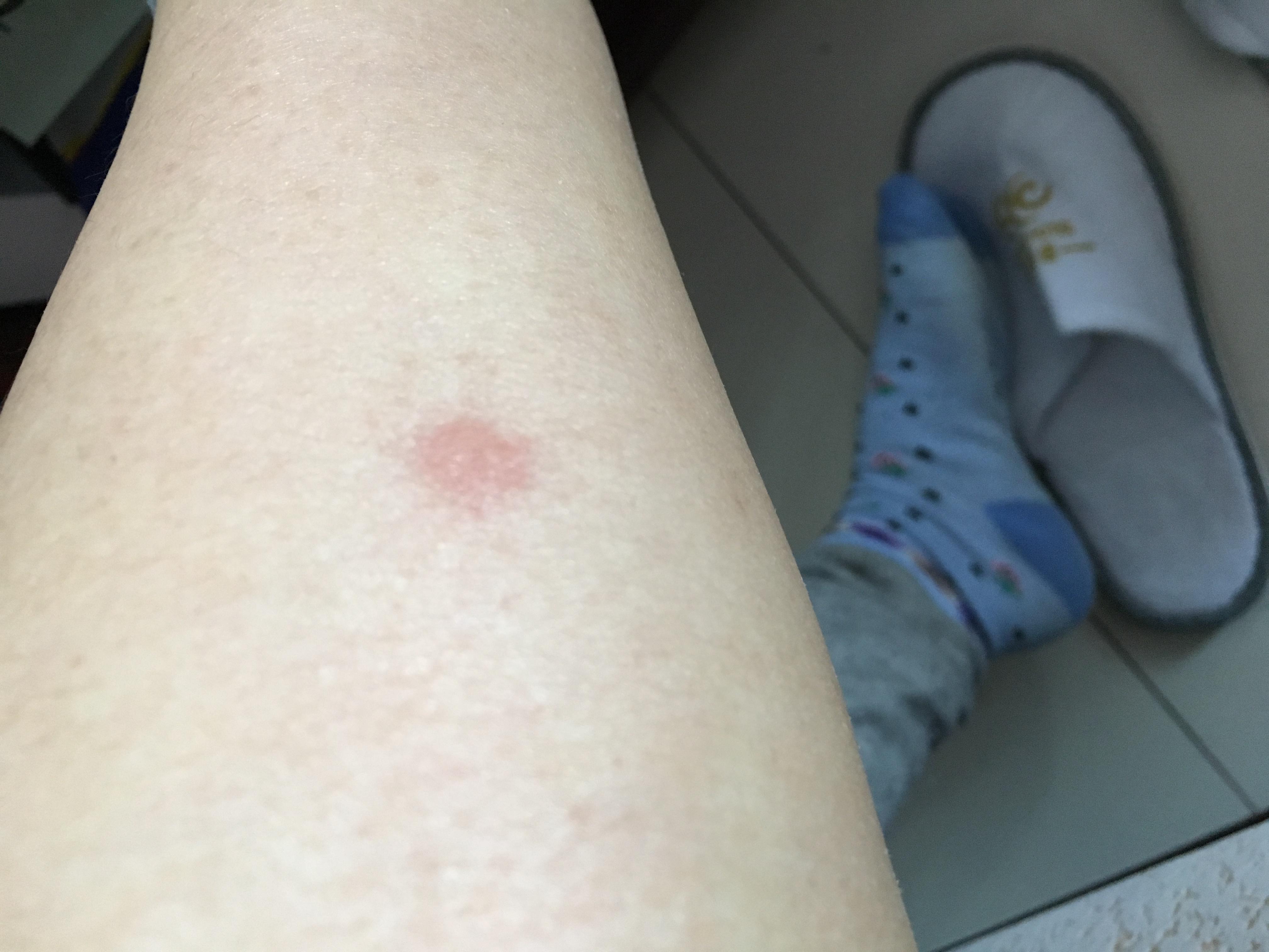 腿上起了红包