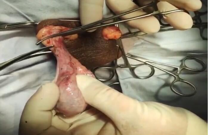 切除睾丸手术男人图片