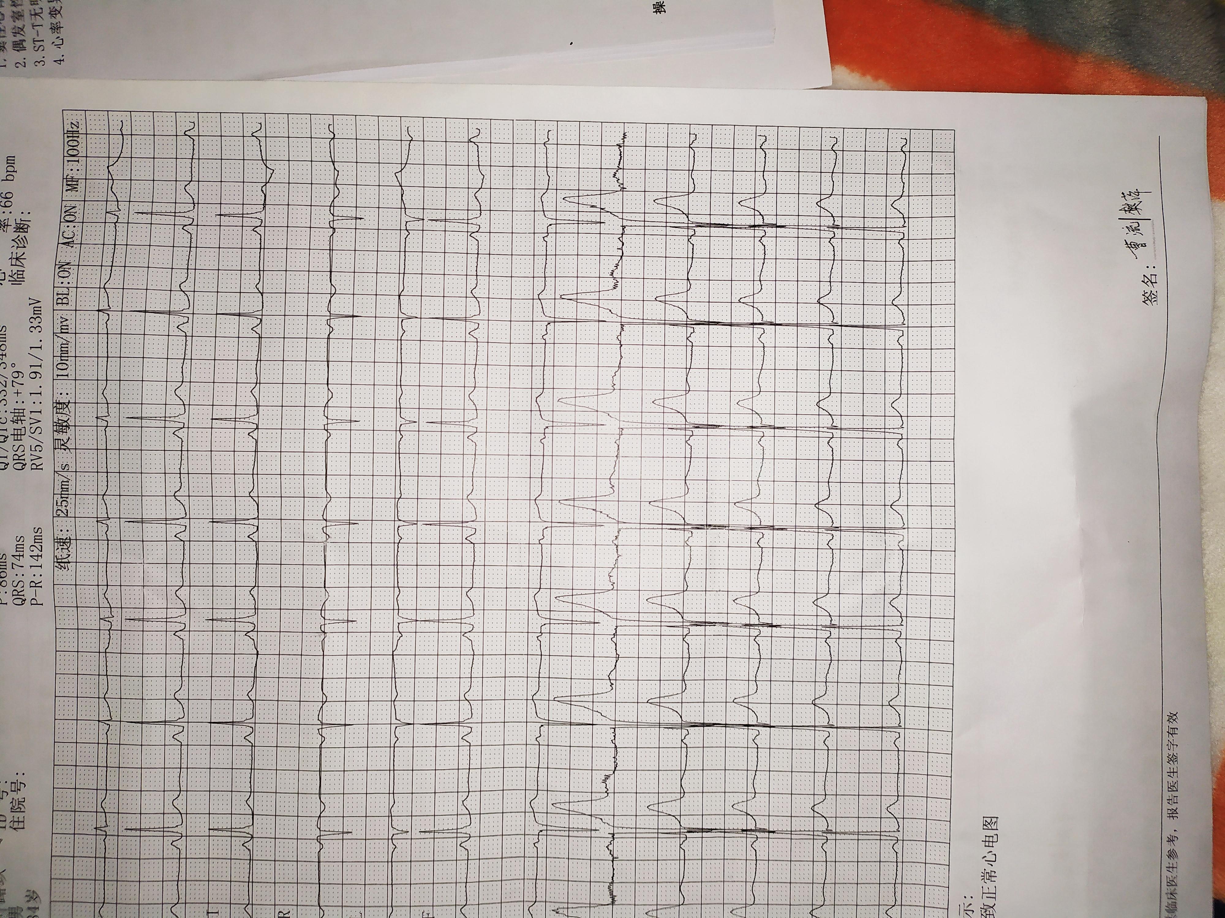 常规心电图v1v2呈qs型